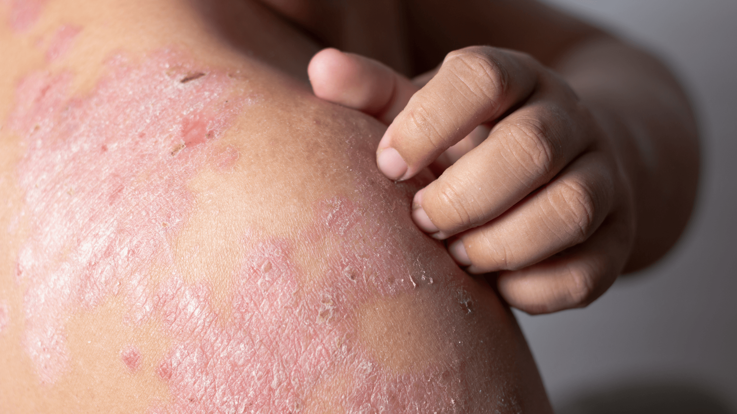 Answers to All of Your Eczema FAQs - Gladskin