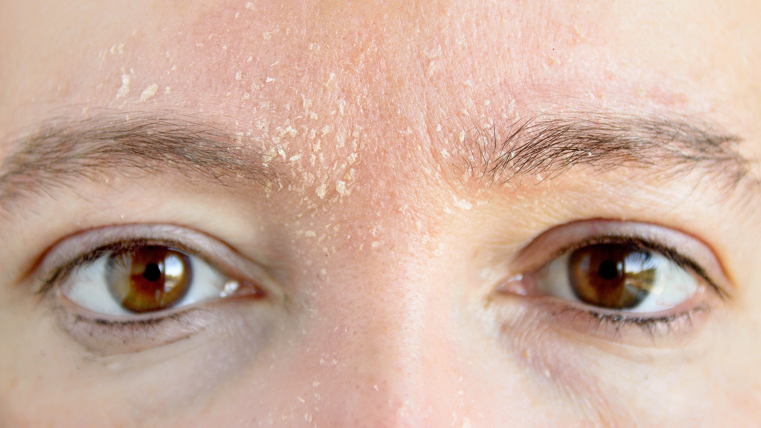 5 Tips for Dealing With Dry and Flaking Skin on Your Face - Gladskin