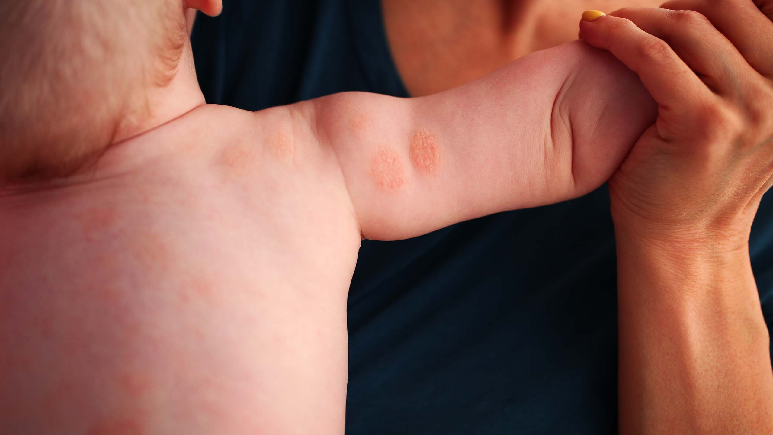 nummular eczema baby