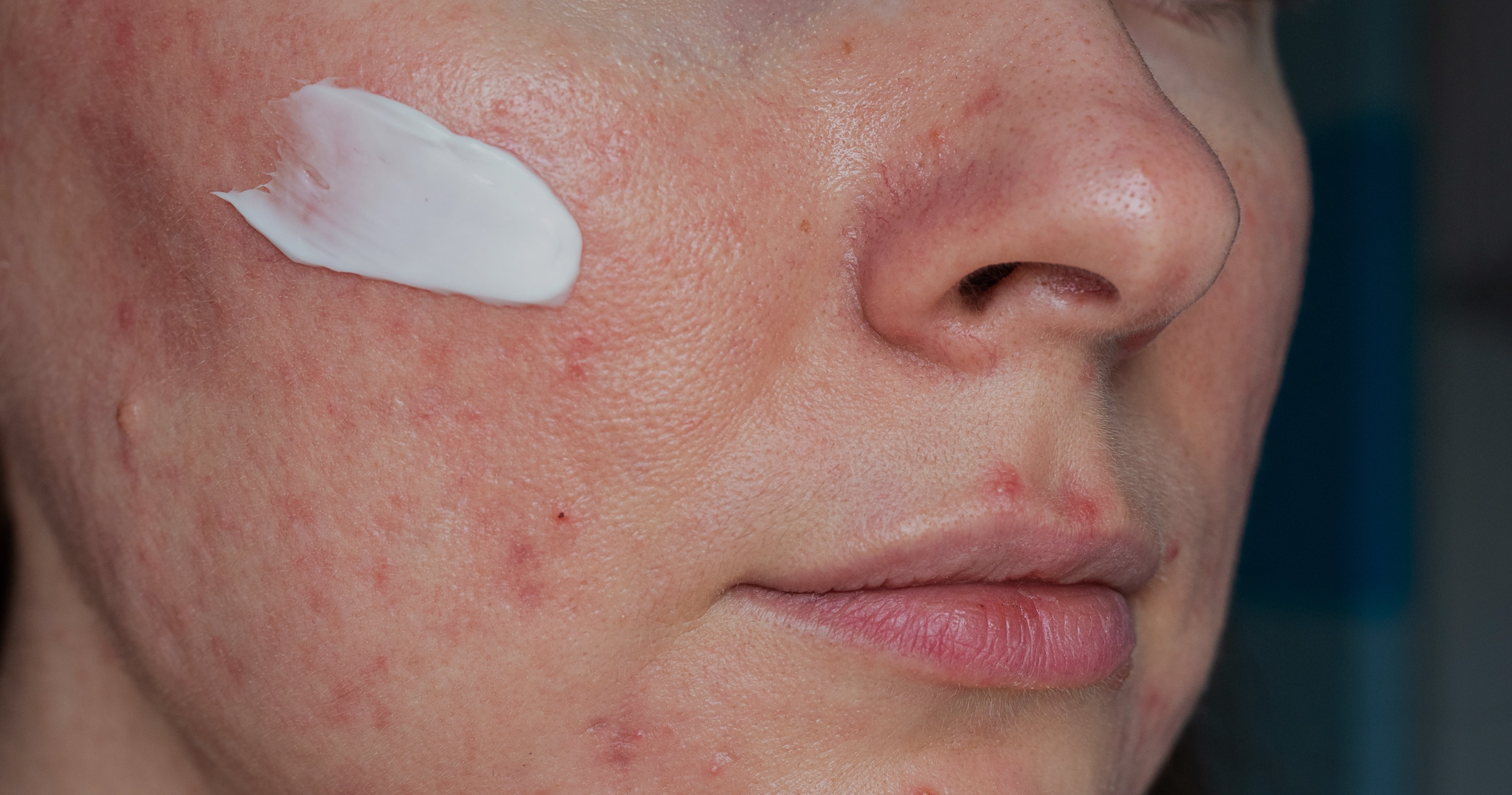 Post-Holiday Skin Recovery: A Routine to Calm, Soothe, and Balance