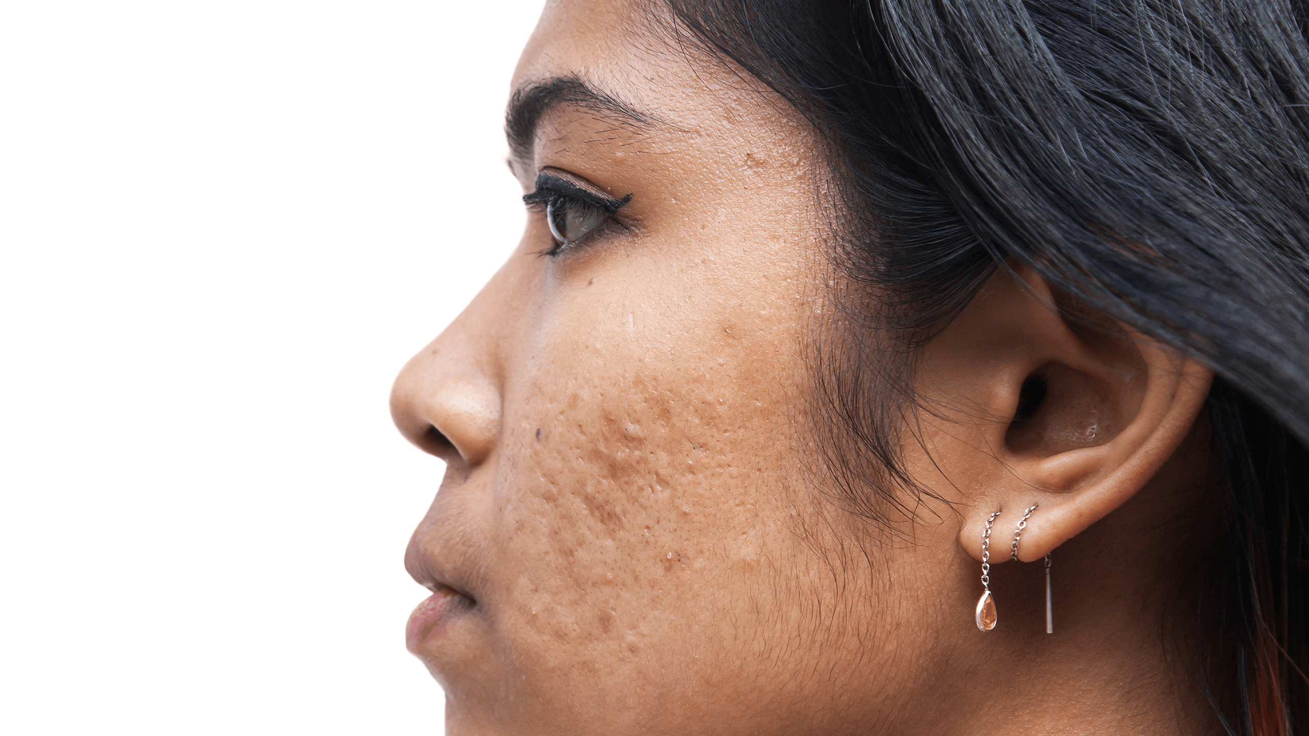 How Are Stress and Acne Connected? - Gladskin