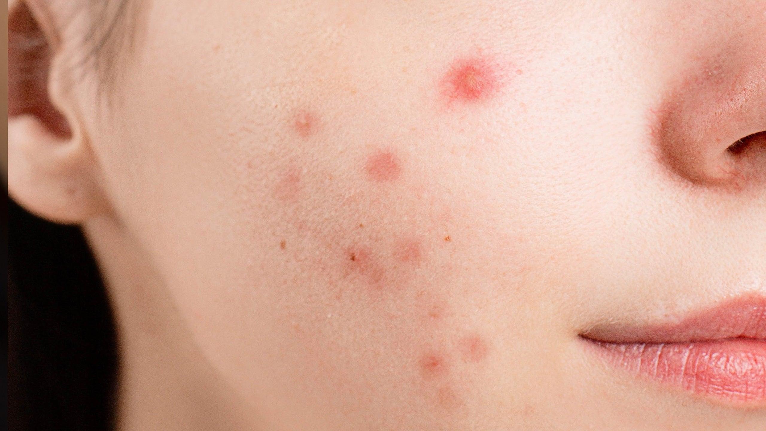 How to Make a Pimple Less Red - Gladskin