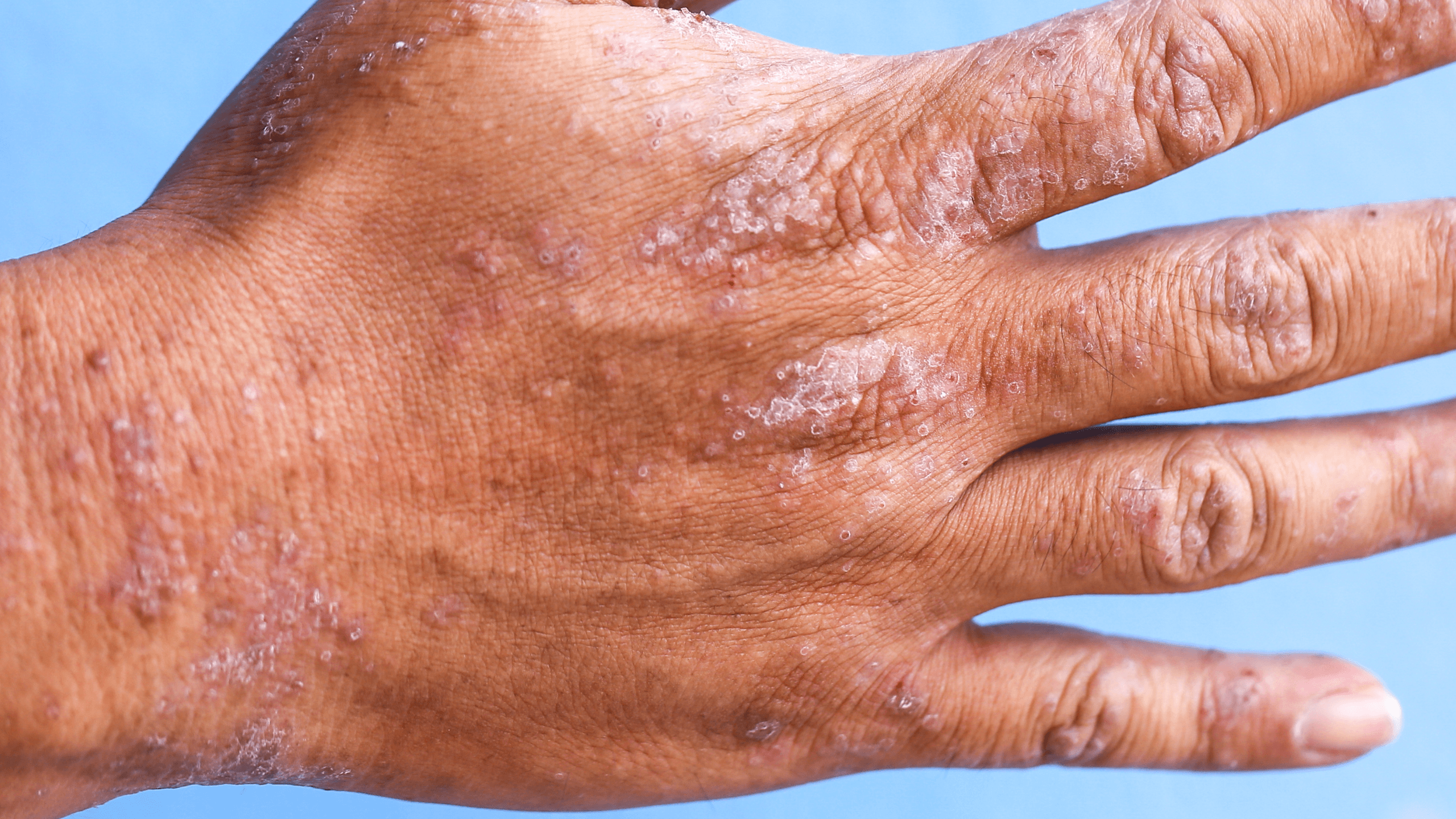 What to Do If Hand Eczema Is Impacting Your Work - Gladskin
