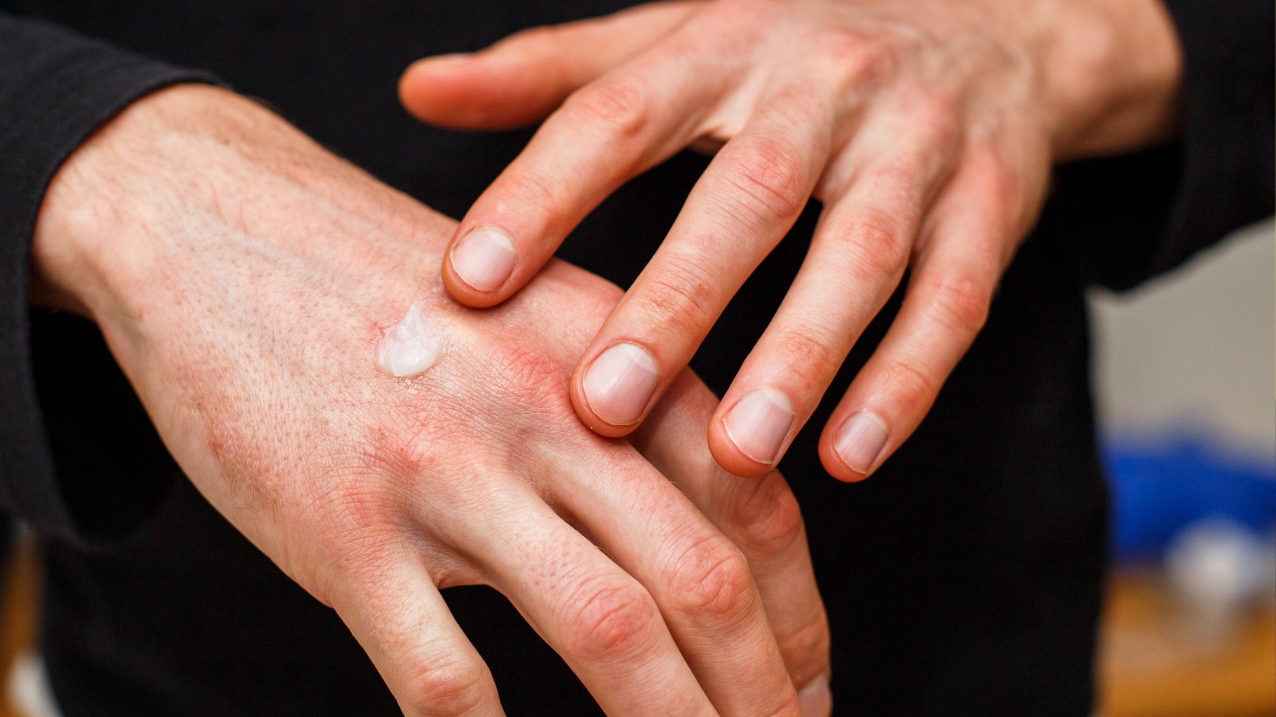 Topical steroid withdrawal: Everything you need to know