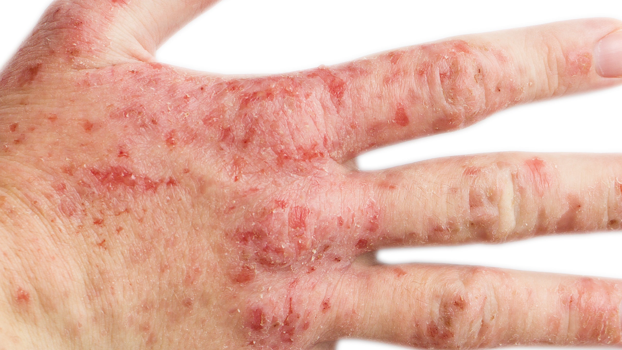 Is Eczema a Disability? - Gladskin