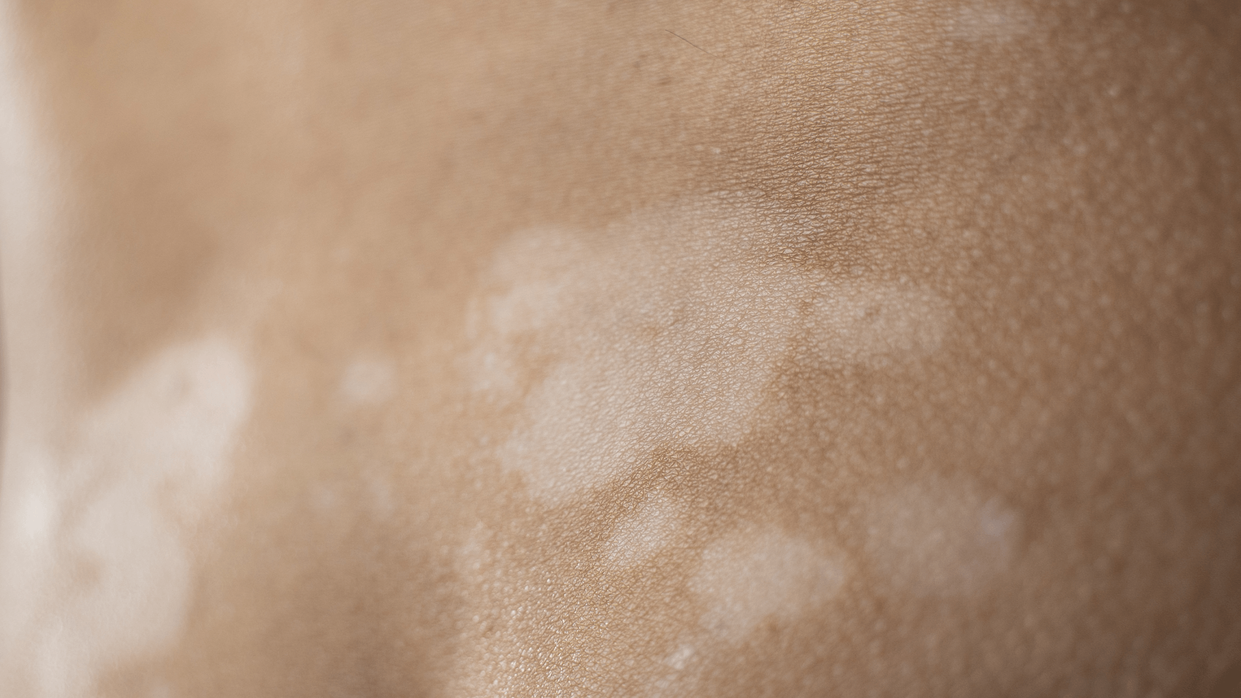 Eczema and Skin Pigmentation: What You Need to Know - Gladskin