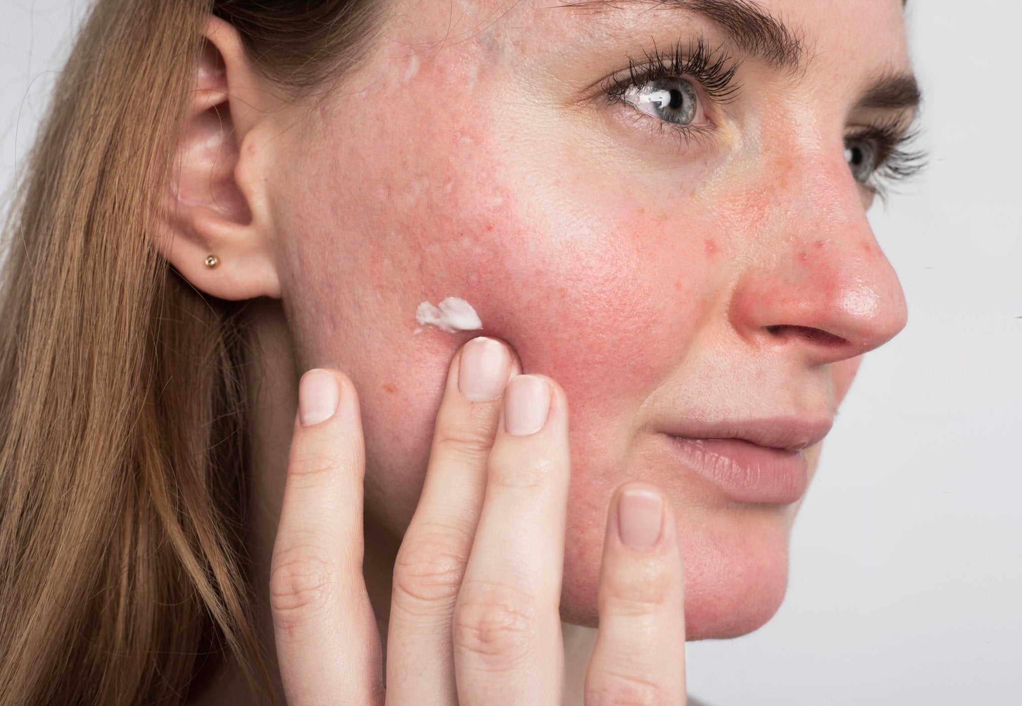 April Is Rosacea Awareness Month - Gladskin