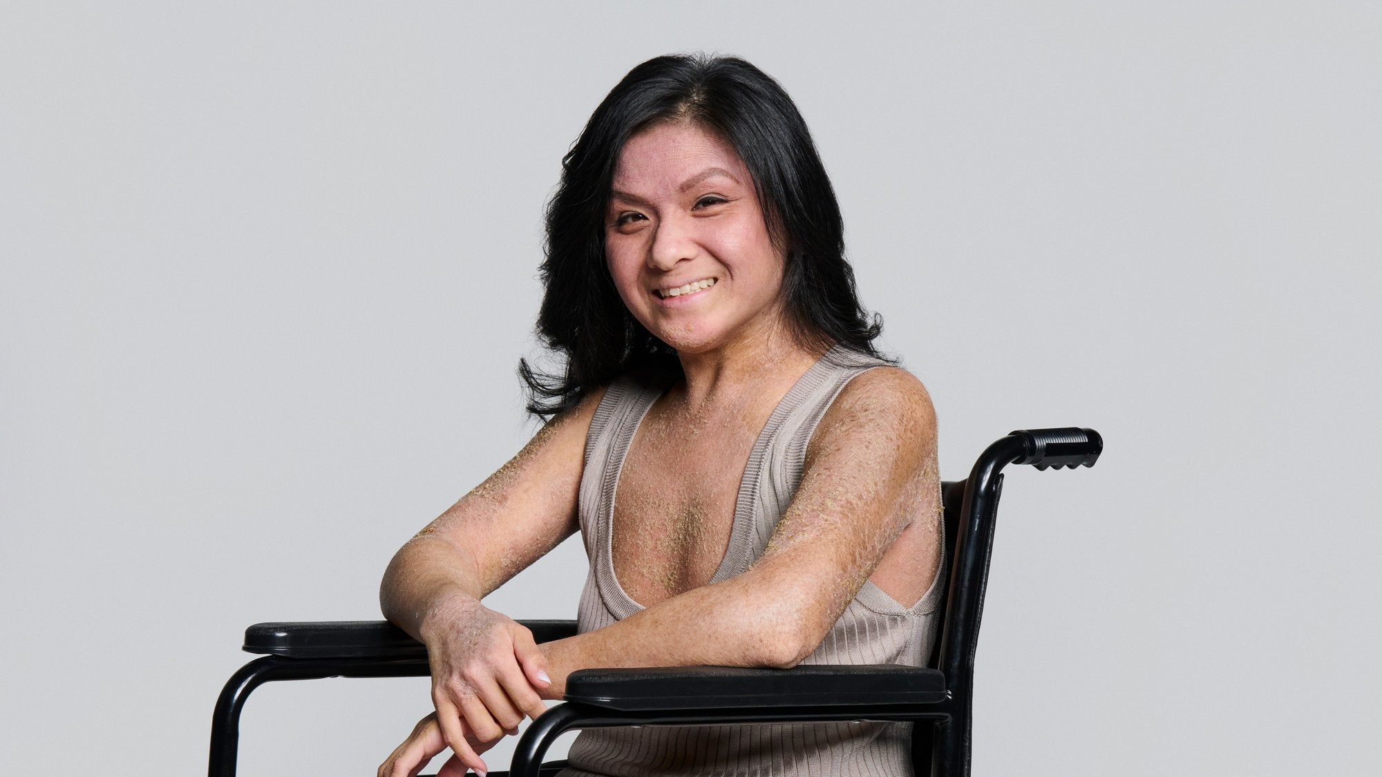 Eczema Community with Linette Roungchun - Gladskin