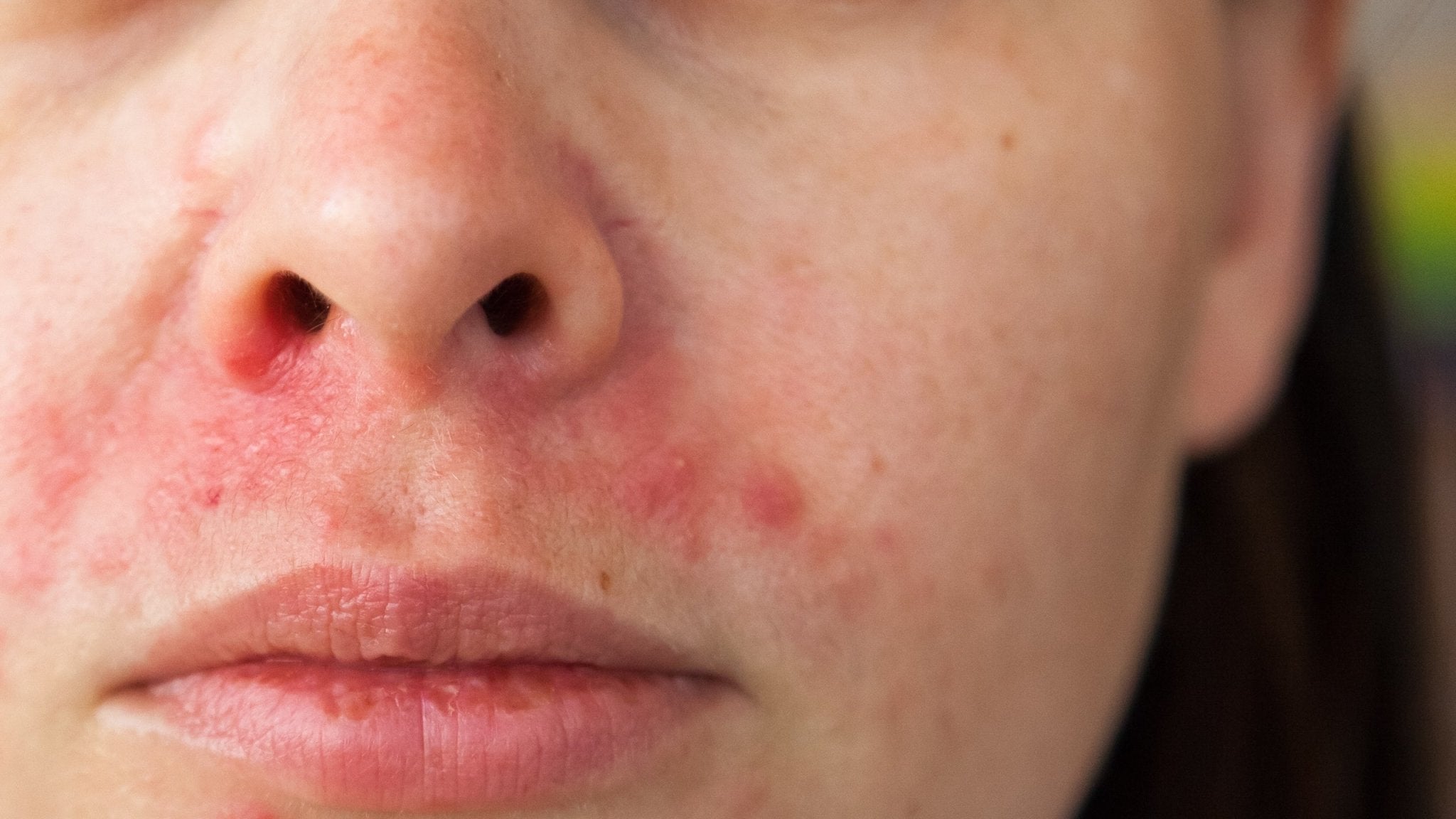 What Is Perioral Dermatitis? Causes, Symptoms, & Treatment - Gladskin