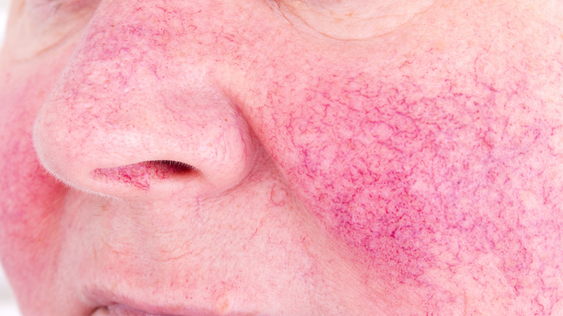 8 Common Causes of Facial Redness