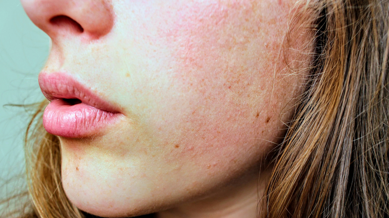 5 Steps to Reduce Facial Redness