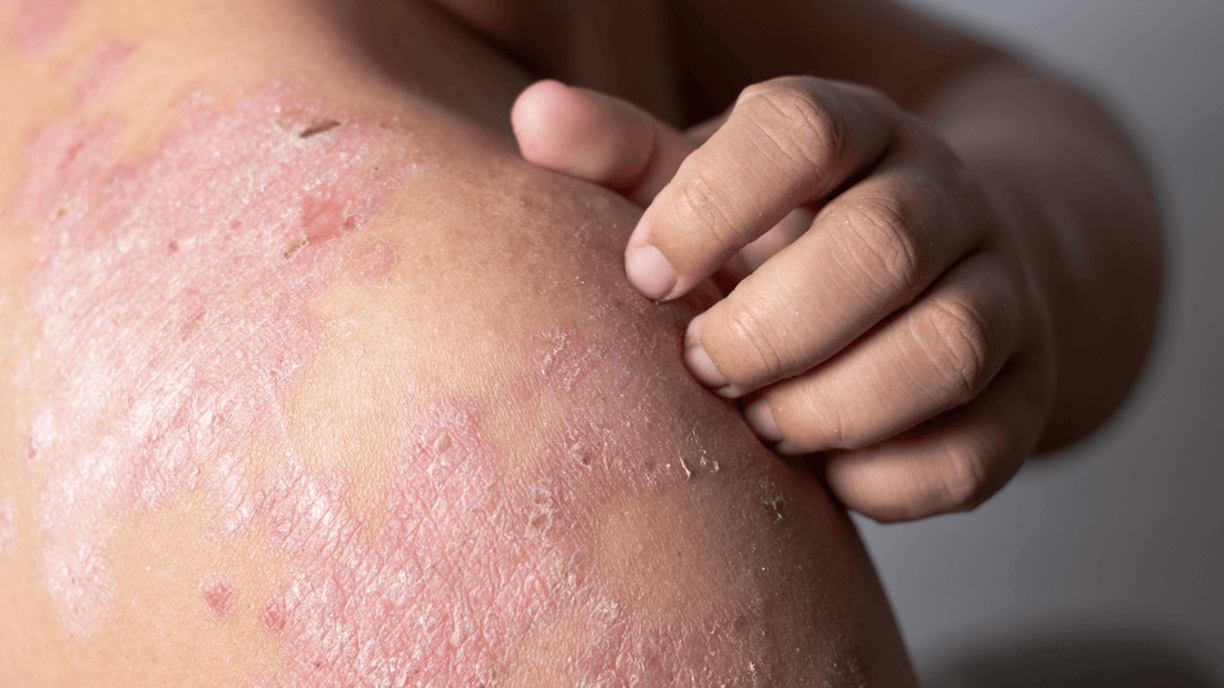 Answers to All of Your Eczema FAQs - Gladskin