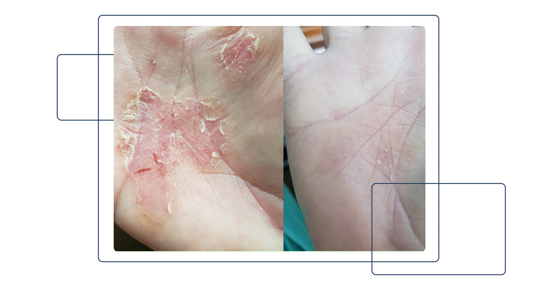 SKIN Journeys: Sonya's Struggle to Find Eczema Treatment & How Gladskin Was the One That Finally Worked - Gladskin