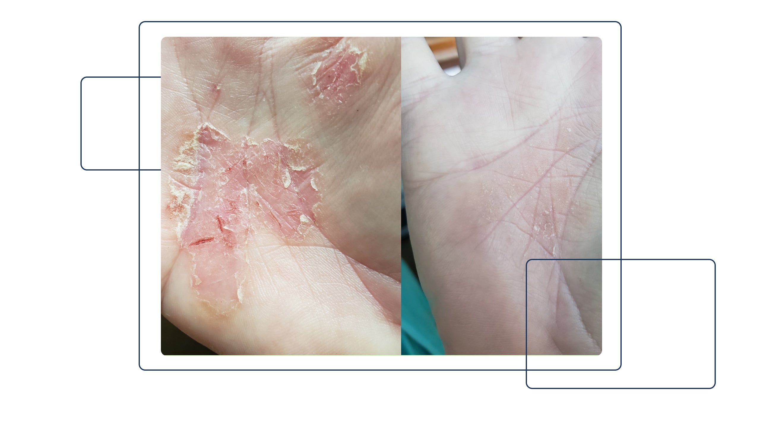 SKIN Journeys: Sonya's Struggle to Find Eczema Treatment & How Gladskin Was the One That Finally Worked - Gladskin