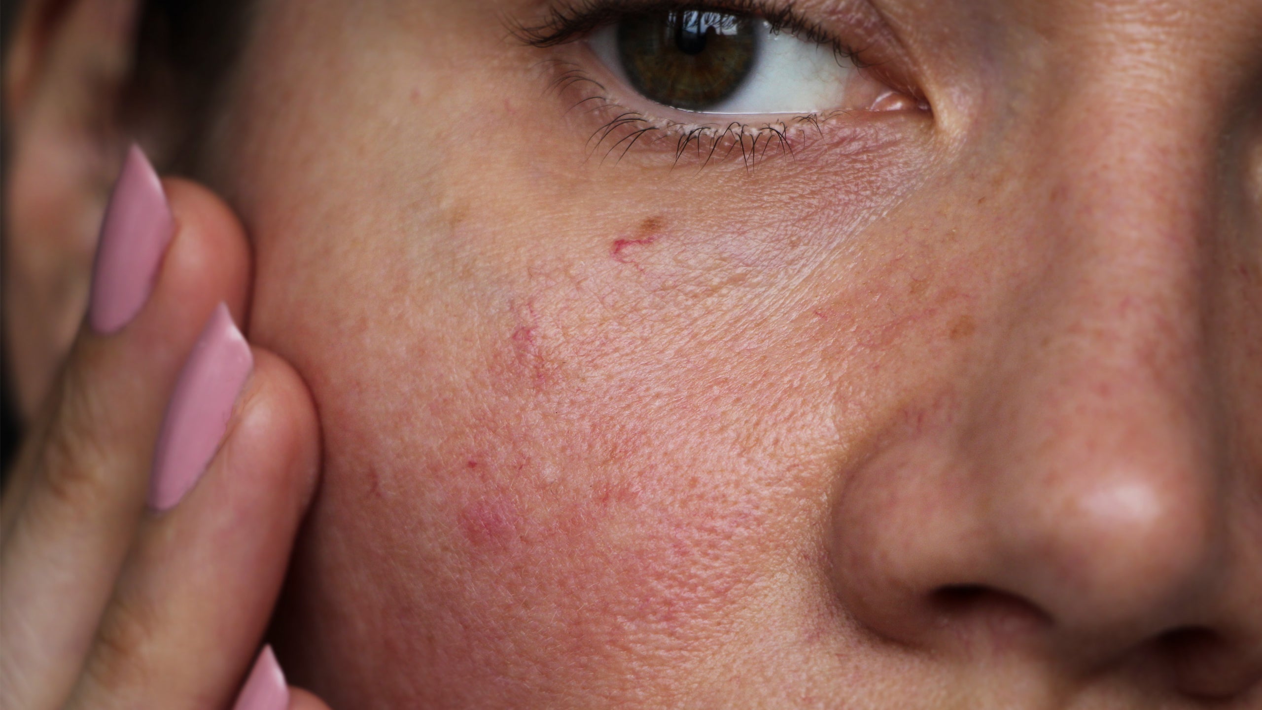 How Skin Mites Contribute to Skin Redness - Gladskin