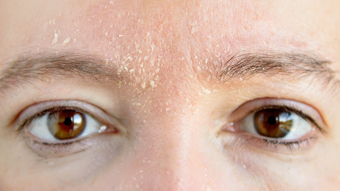5 Tips for Dealing With Dry and Flaking Skin on Your Face - Gladskin