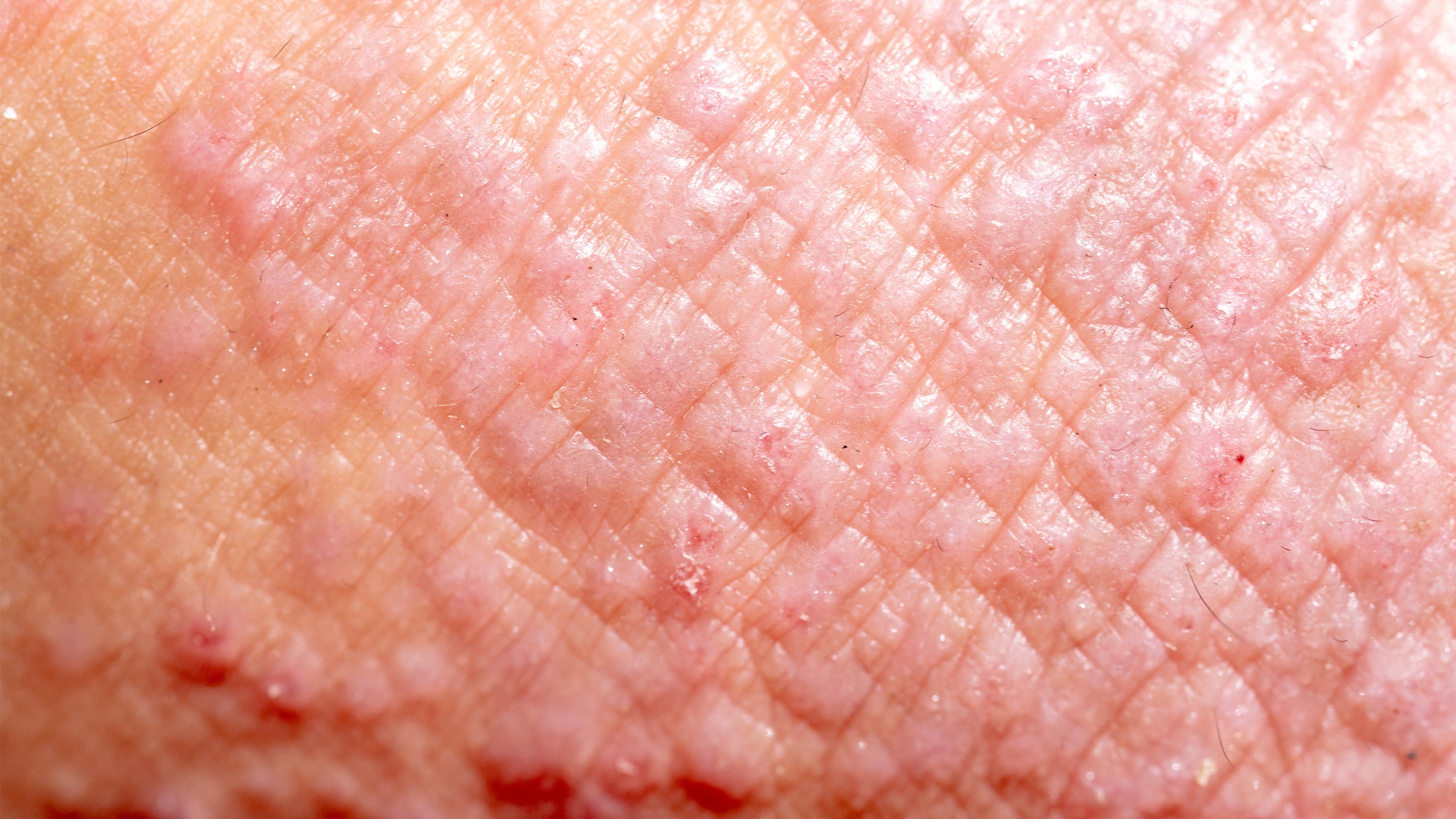 Types of Eczema: Contact Dermatitis - Gladskin