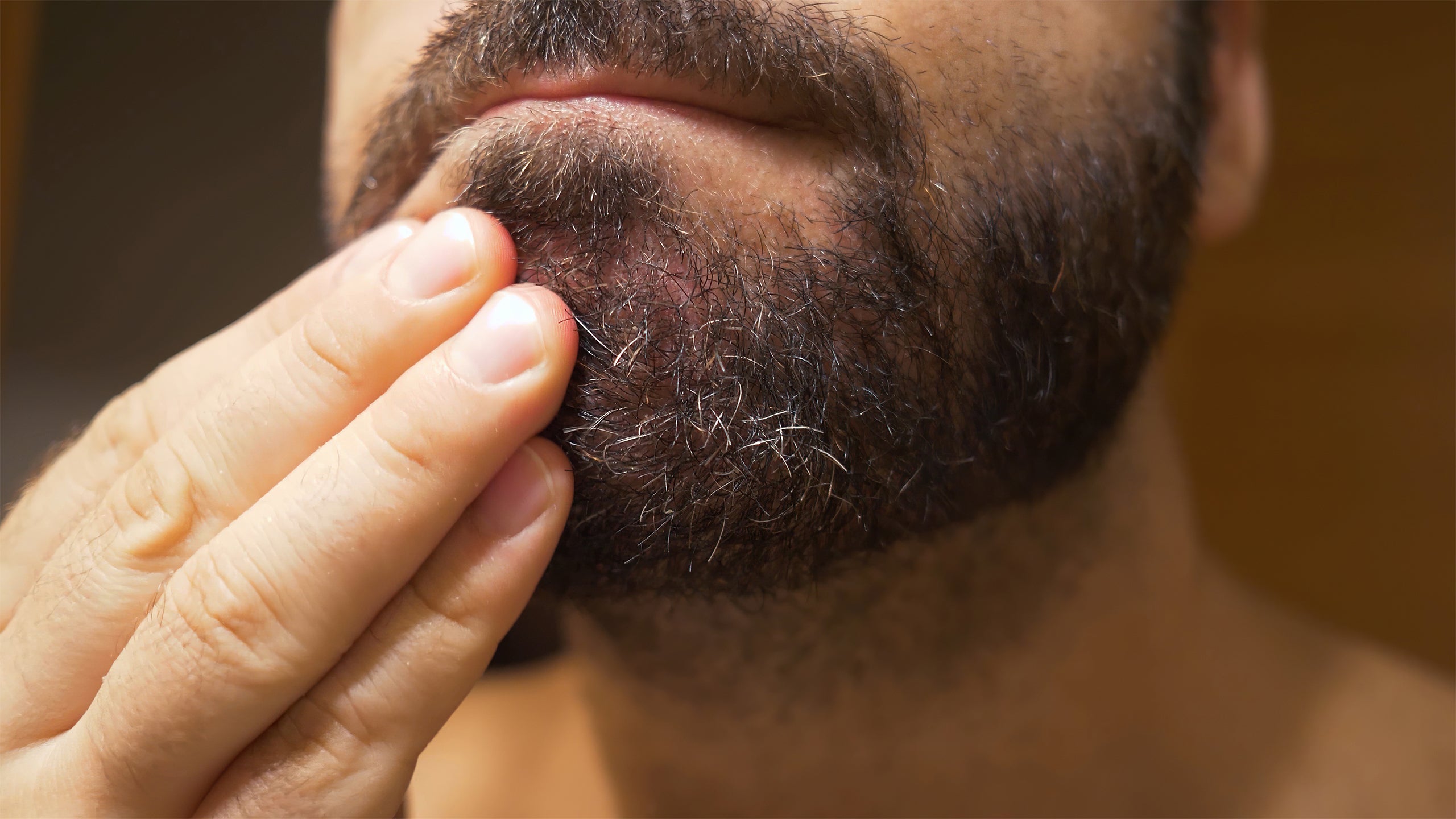 Types of Eczema: Seborrheic Dermatitis - Gladskin