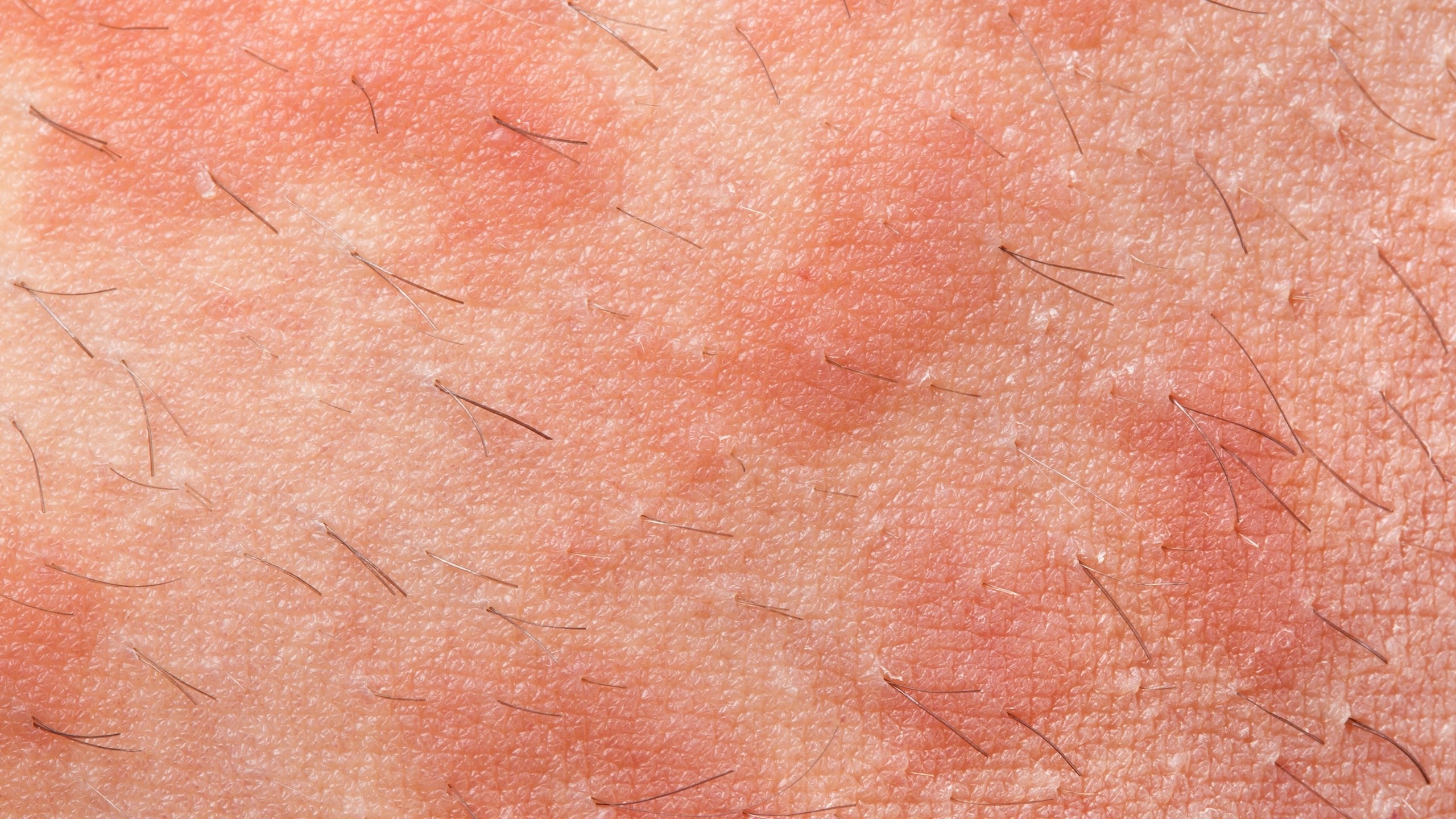 Types of Eczema: Atopic Dermatitis - Gladskin