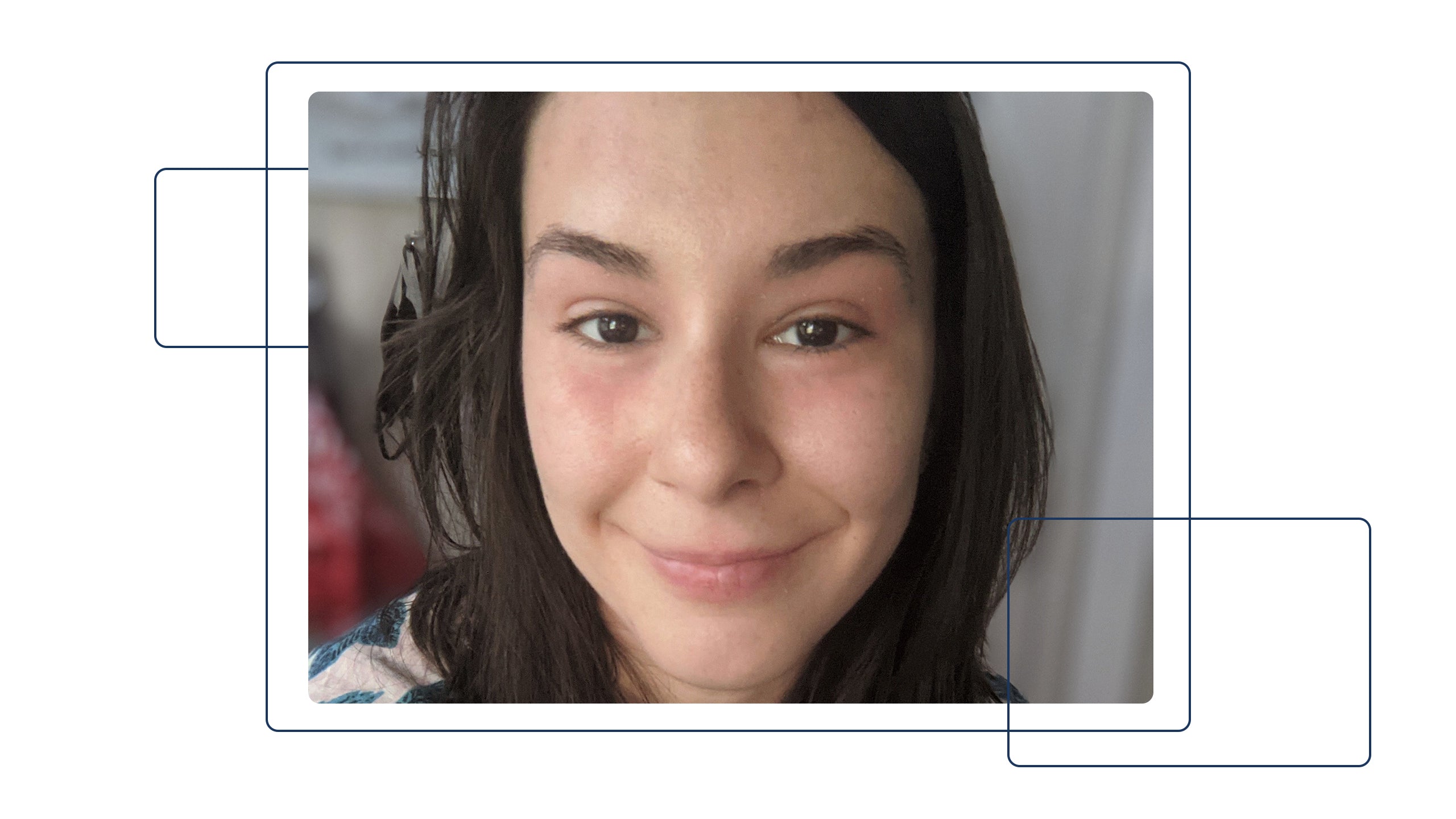 SKIN Journeys: How Emily Healed Her Eczema by Identifying Her Triggers and Rebalancing Her Microbiome - Gladskin