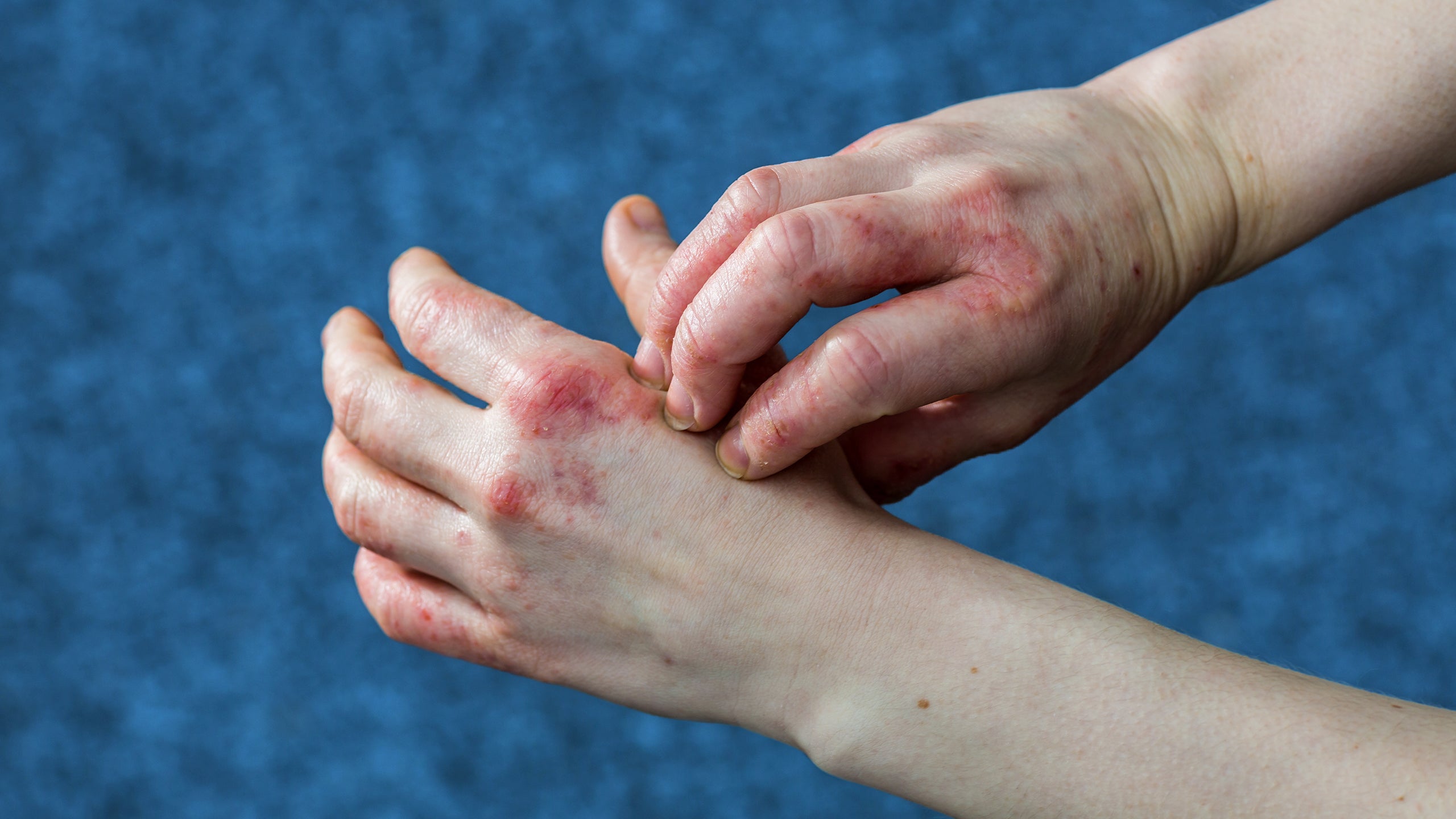 What Is Dyshidrotic Eczema? - Gladskin