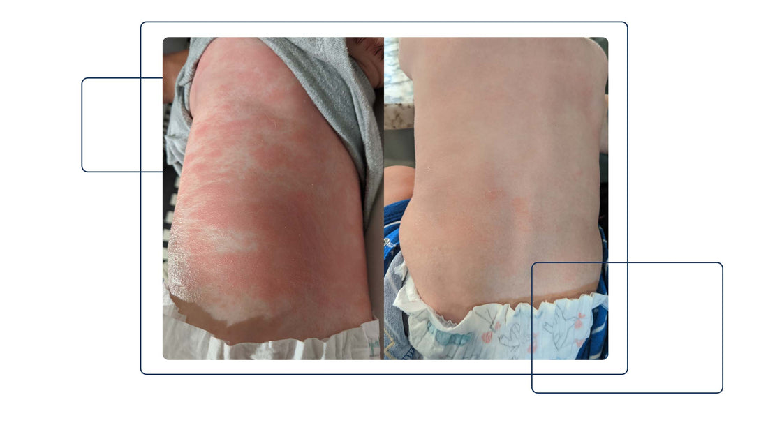 SKIN Journeys: Nicole Calls Gladskin a Miracle for Baby Michael - Gladskin