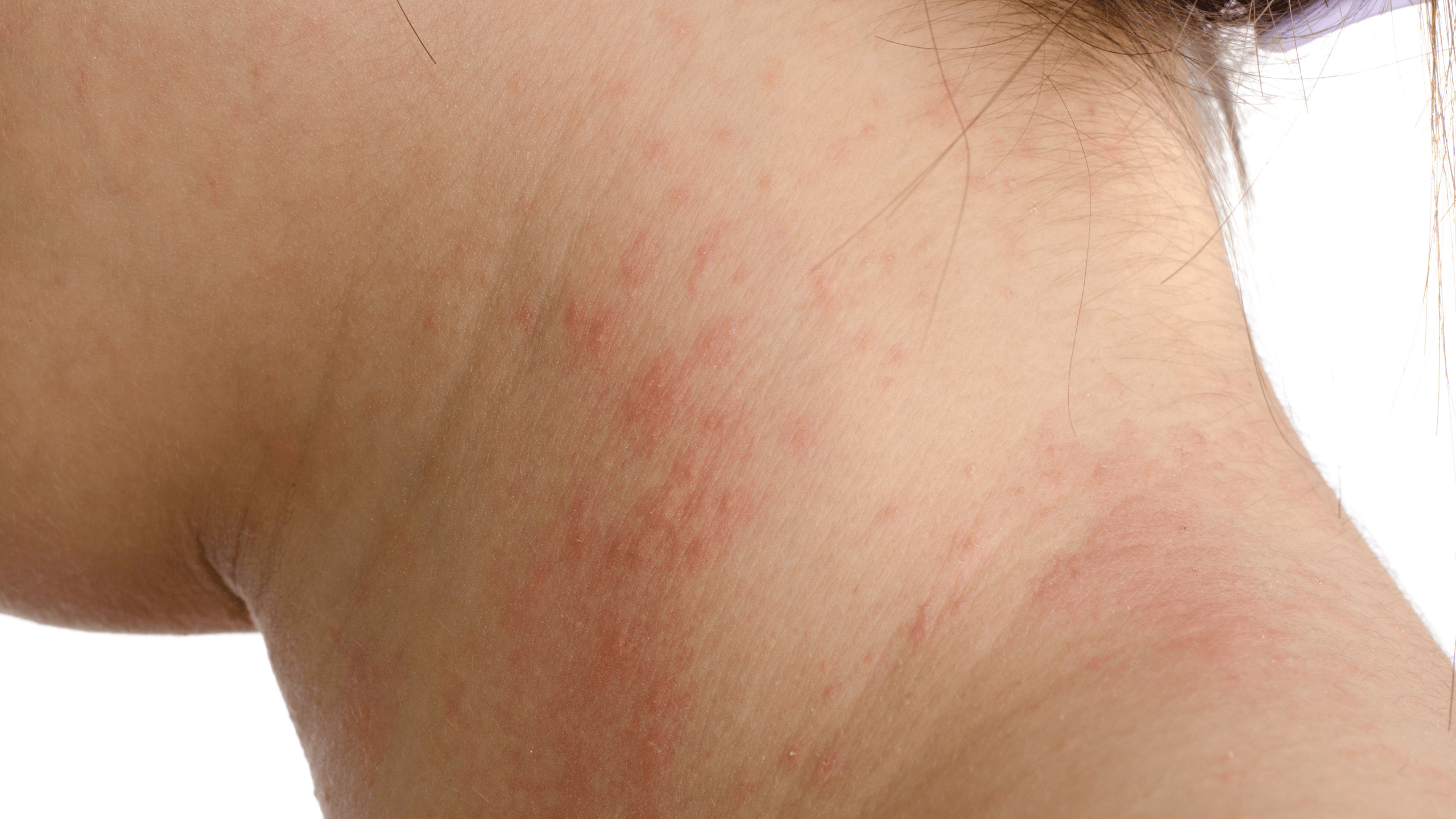 7 Types of Eczema: Causes, Symptoms, & Treatments - Gladskin