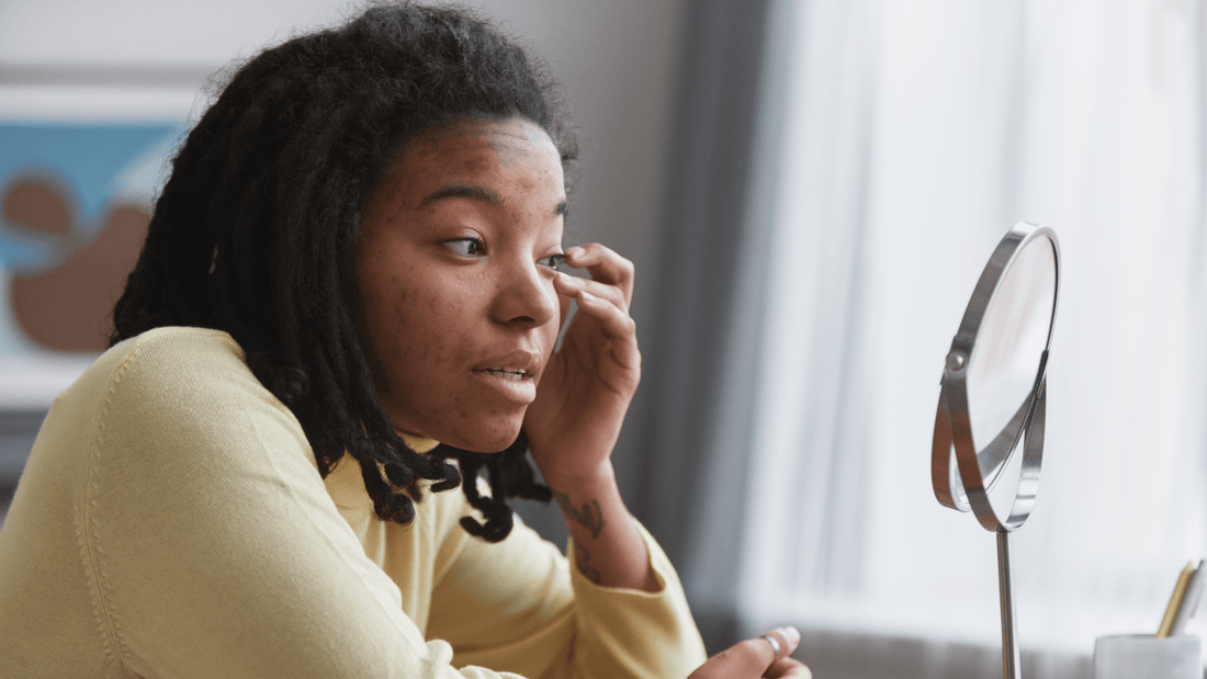 What You Need to Know About Rosacea in Skin of Color - Gladskin