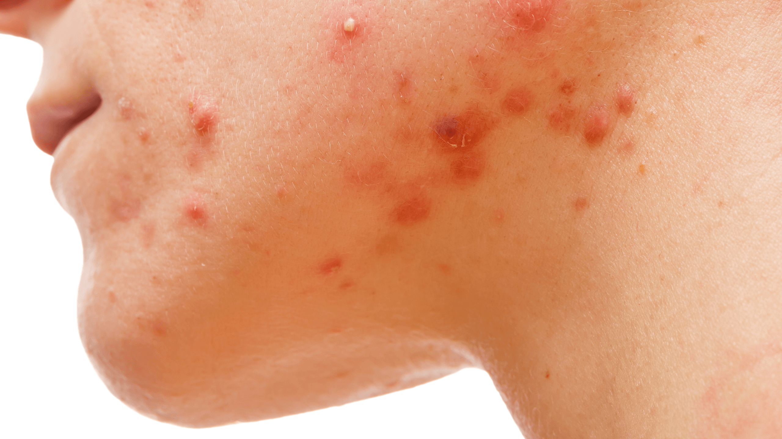 What Is Skin Purging, and Is It Happening to Me? - Gladskin