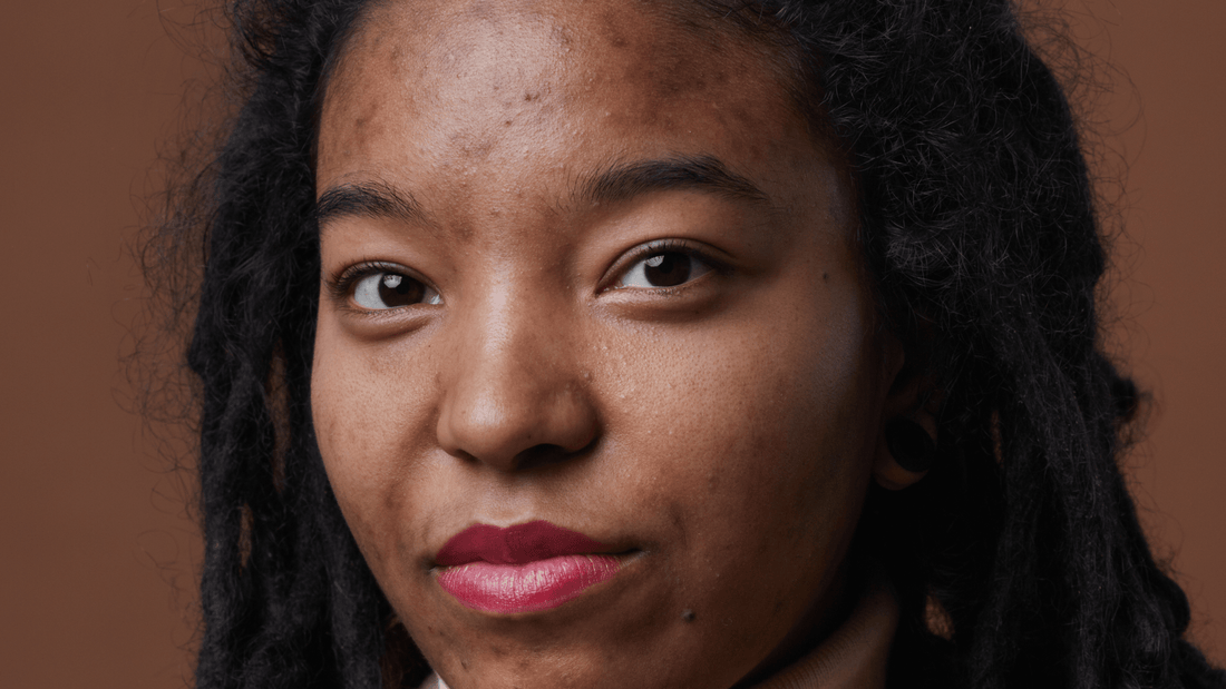 Five Acne Myths to Shatter - Gladskin