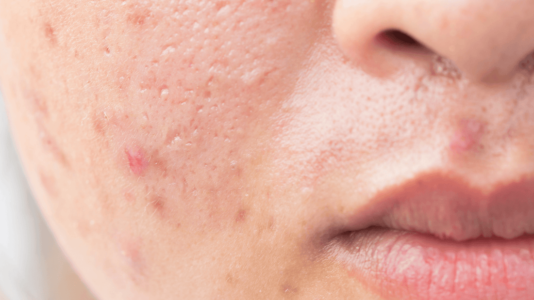 How to Treat an Infected Pimple - Gladskin