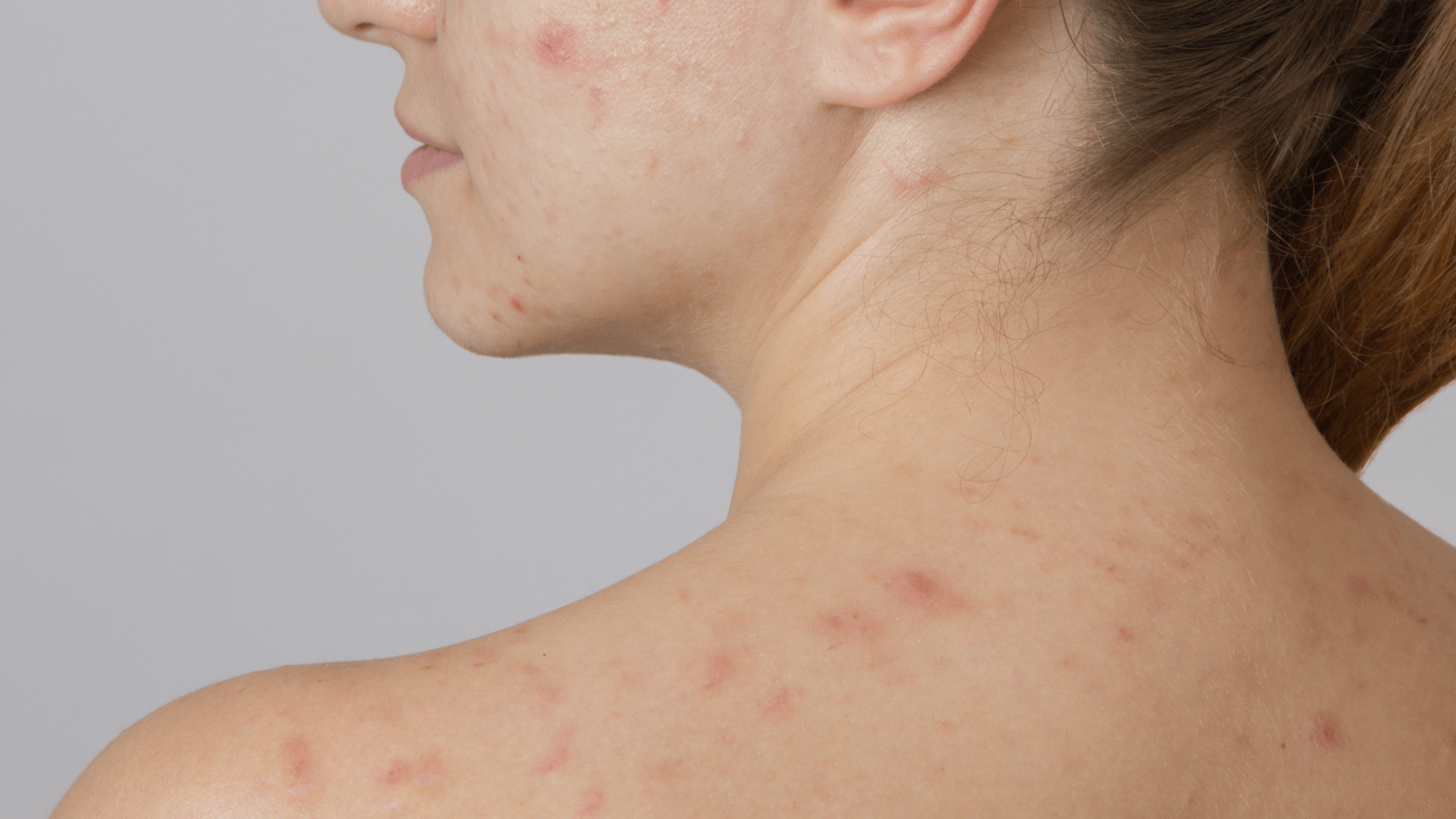 The Low Down on Acne in Your 20s, 30s, and 40s - Gladskin
