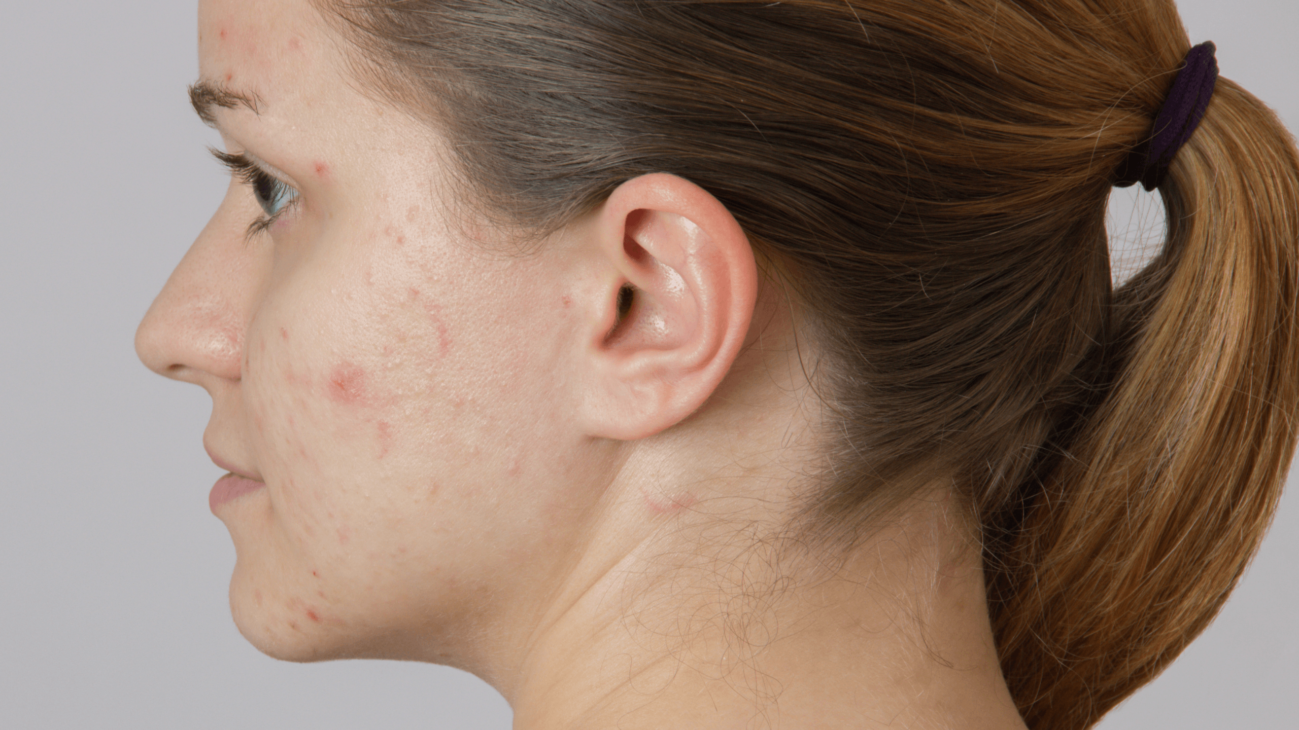 The Importance of a Healthy Skin Barrier in Acne-Prone Skin - Gladskin