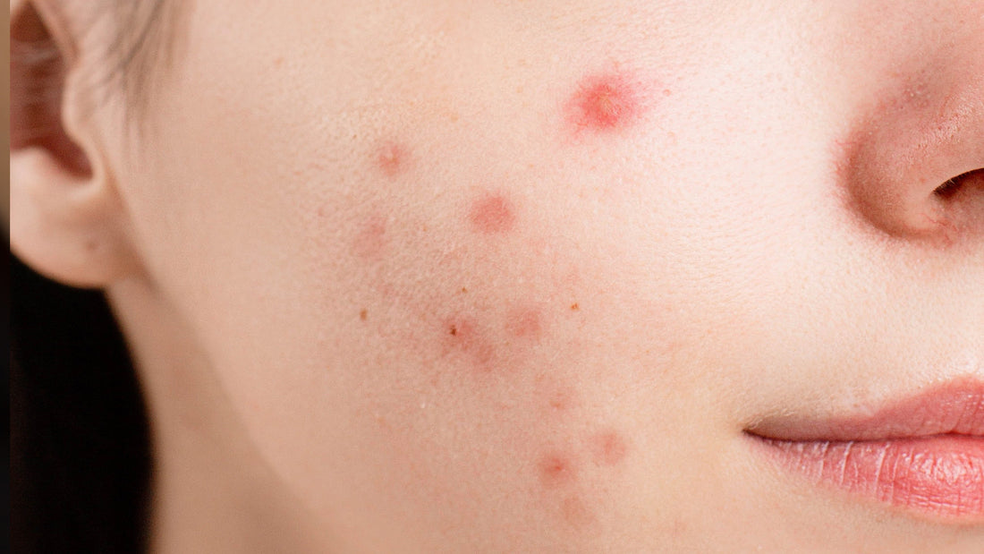 How to Make a Pimple Less Red - Gladskin