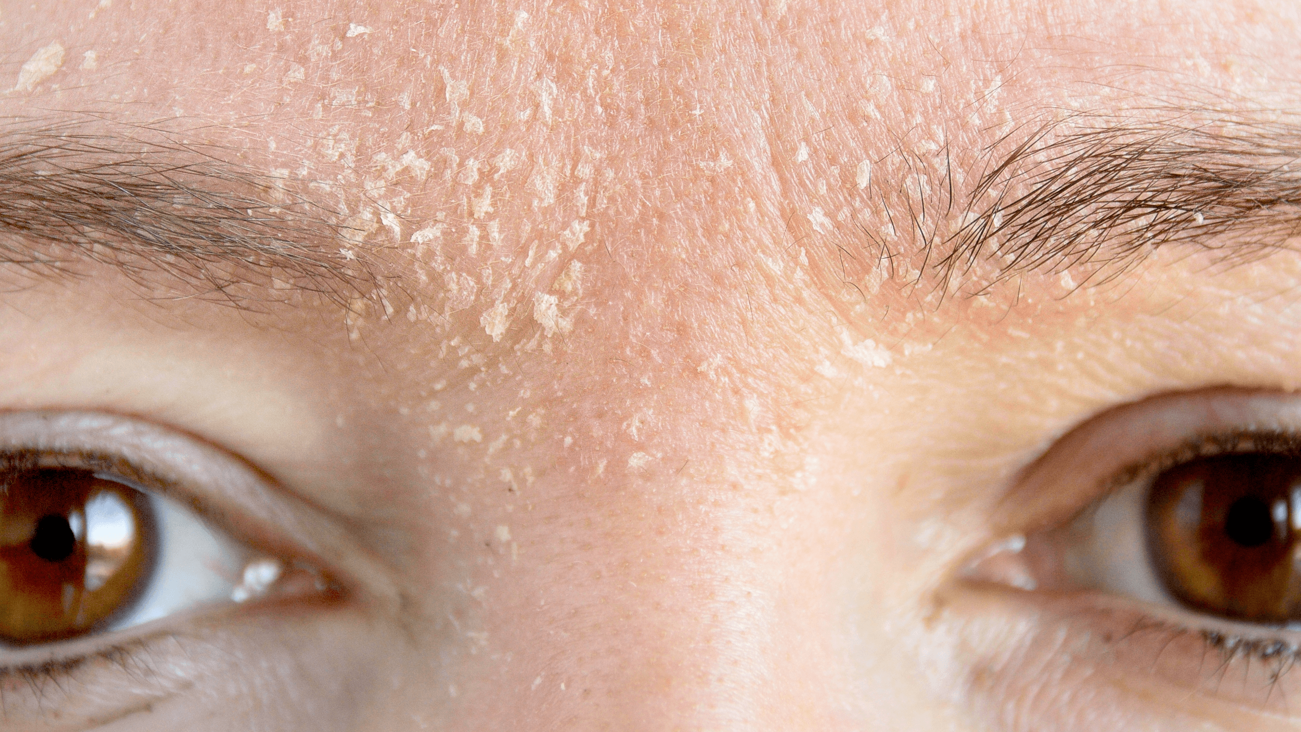 How to Repair the Skin Barrier if You Have Eczema or Rosacea - Gladskin