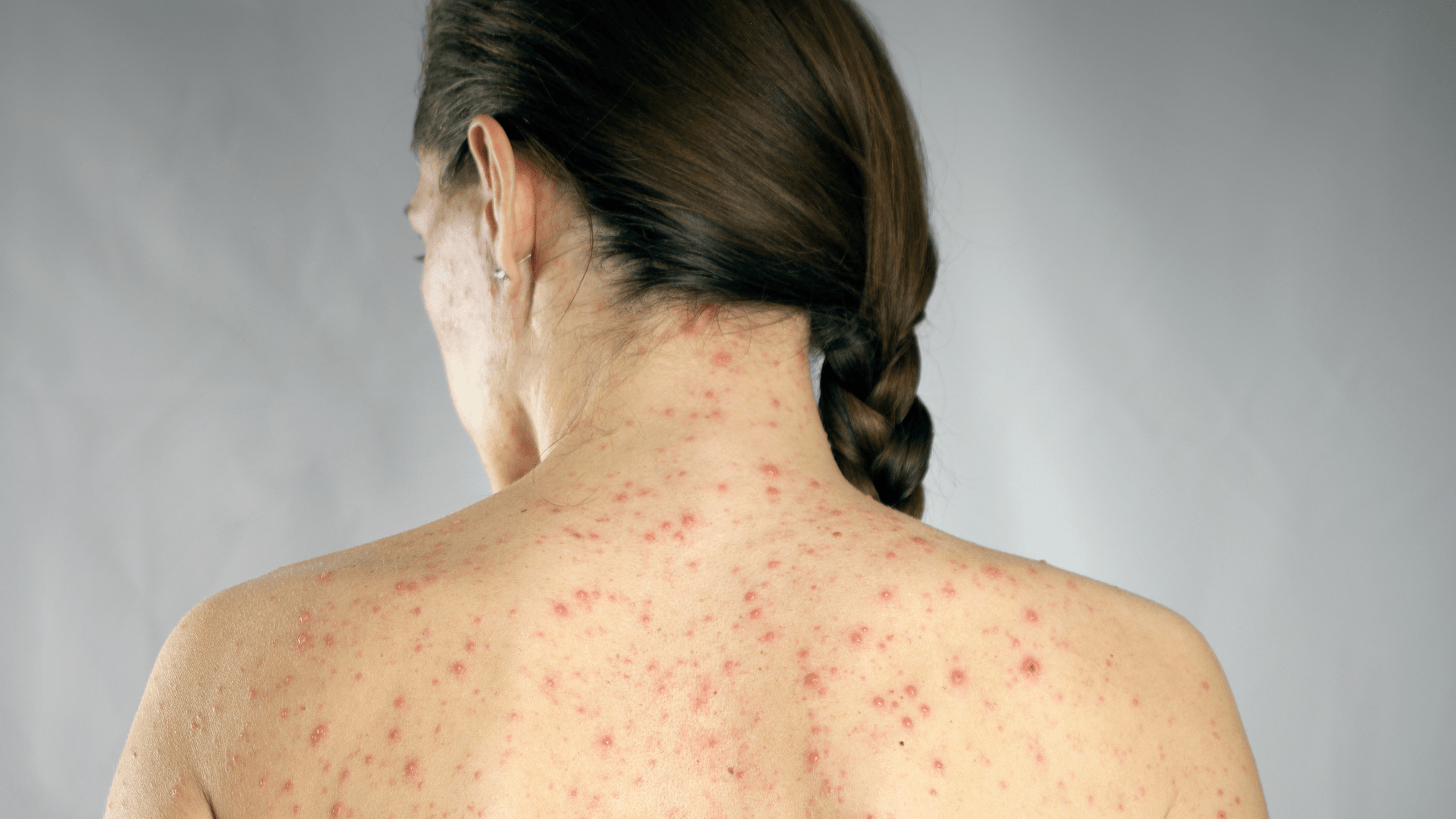 How to Deal With Acne and Eczema - Gladskin