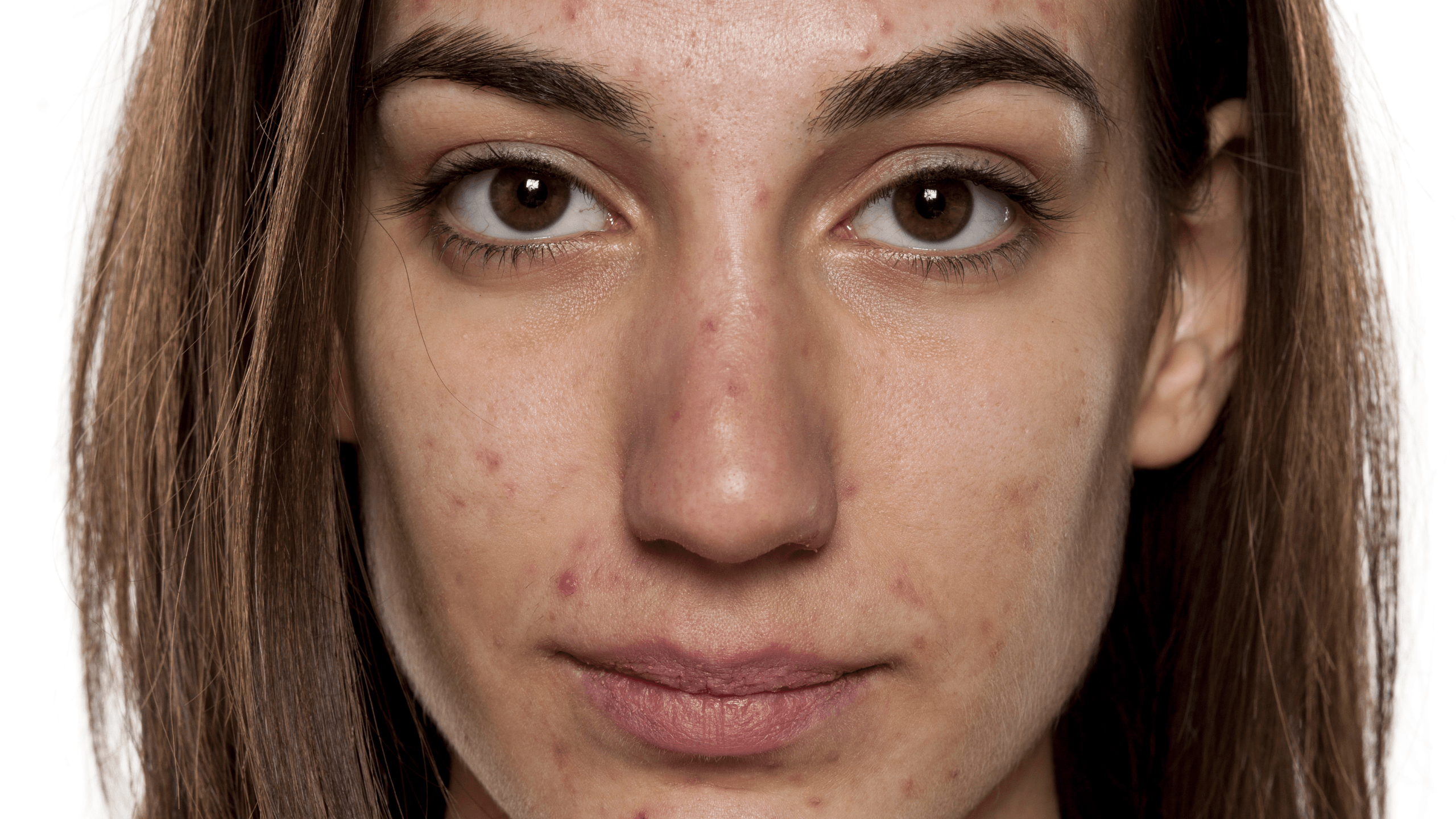 Why Not to Pop Pimples - Gladskin