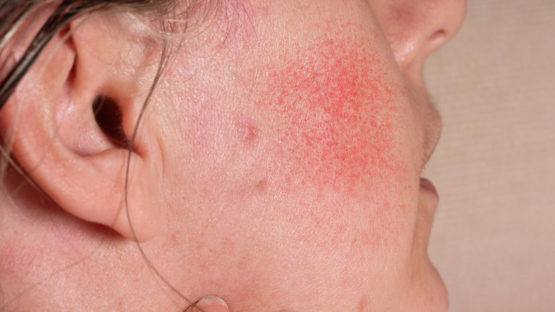 Ivermectin and Rosacea: What You Need to Know - Gladskin