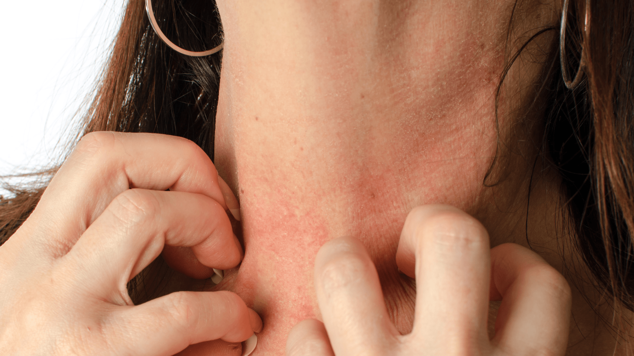 The Link Between Eczema & Stress - Gladskin