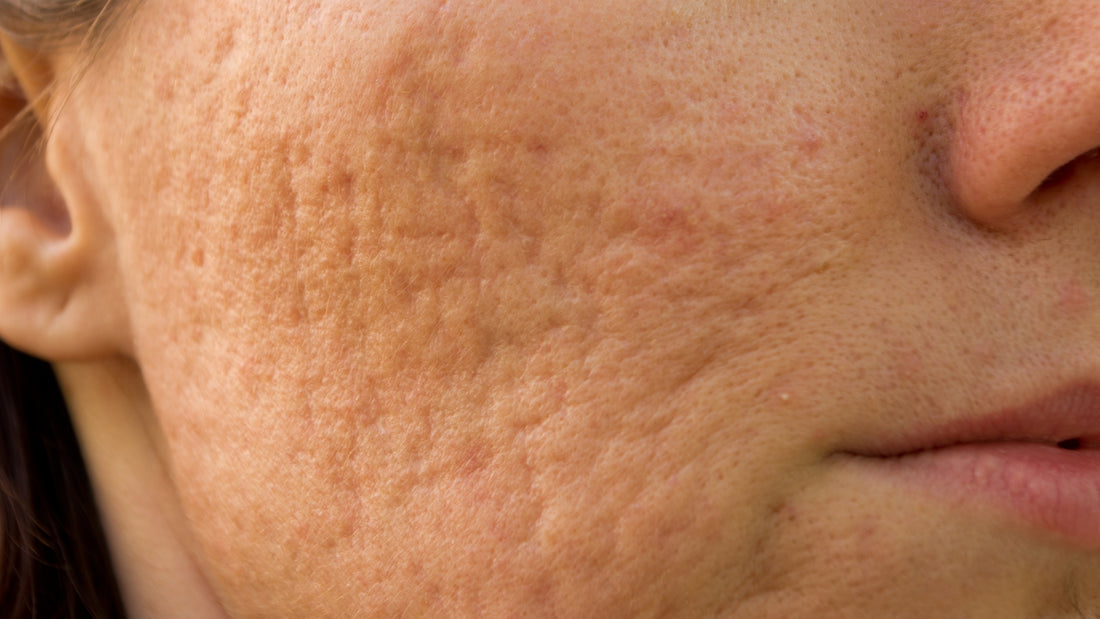 How to Treat Acne Scarring - Gladskin