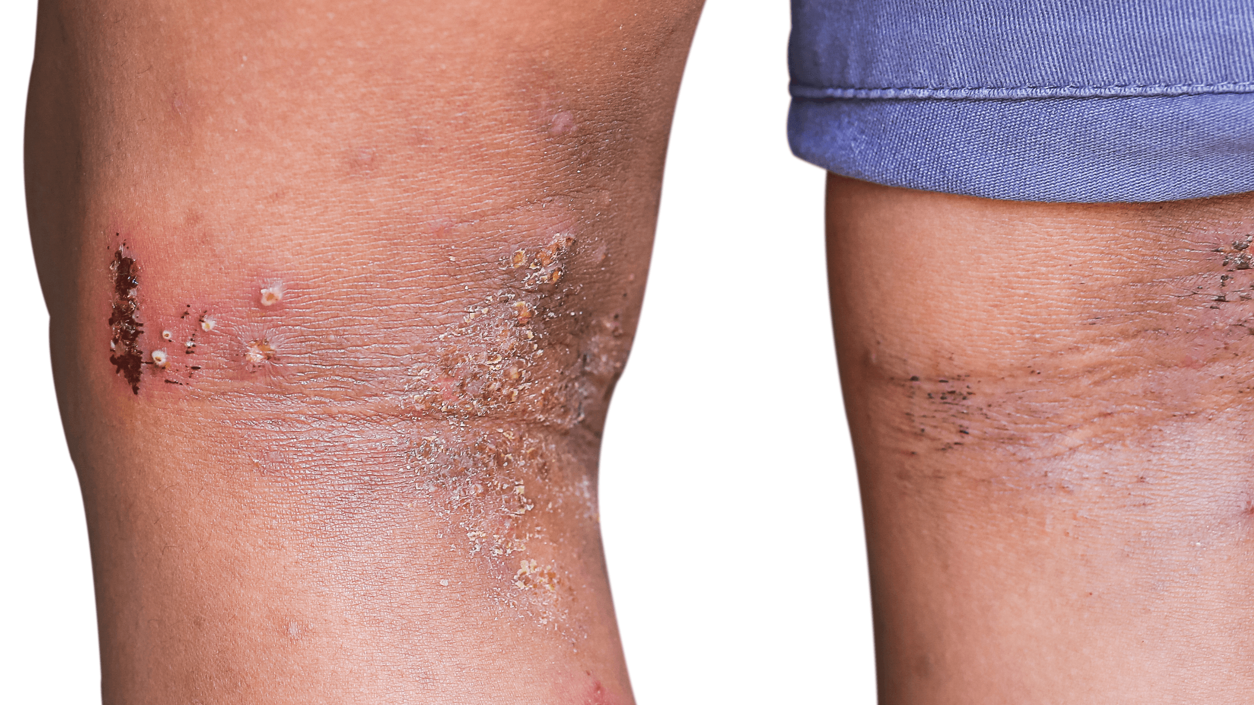 Skin Inflammation: Causes, Effects, and Treatments - Gladskin
