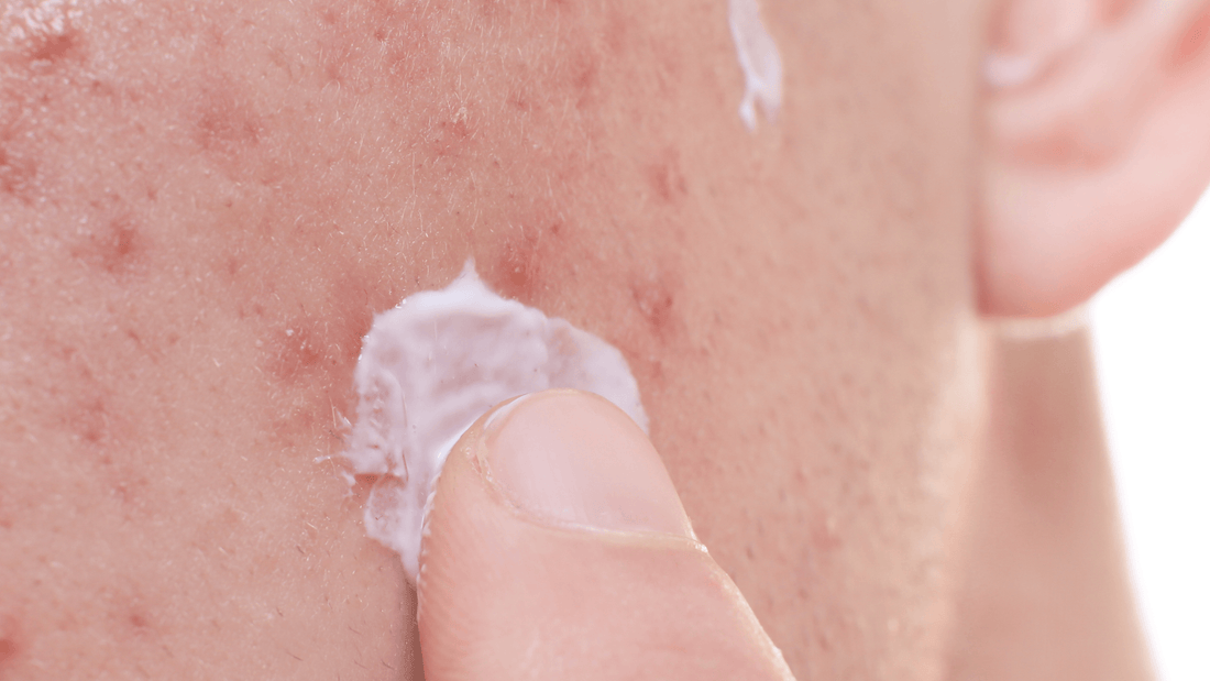 Chronic Acne vs. Breakouts - Gladskin