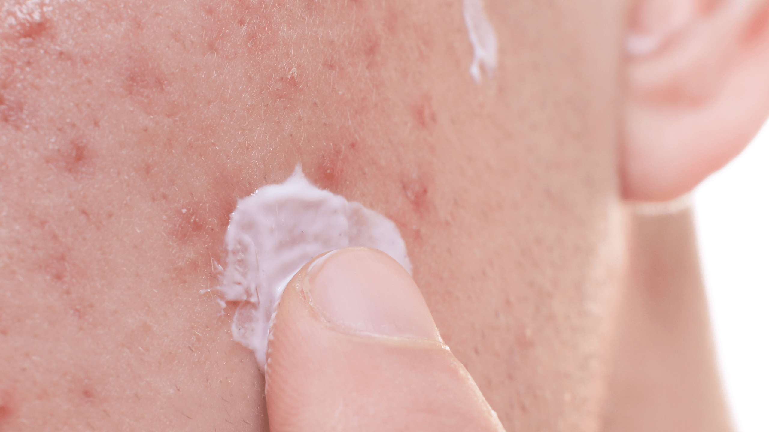 Chronic Acne vs. Breakouts - Gladskin