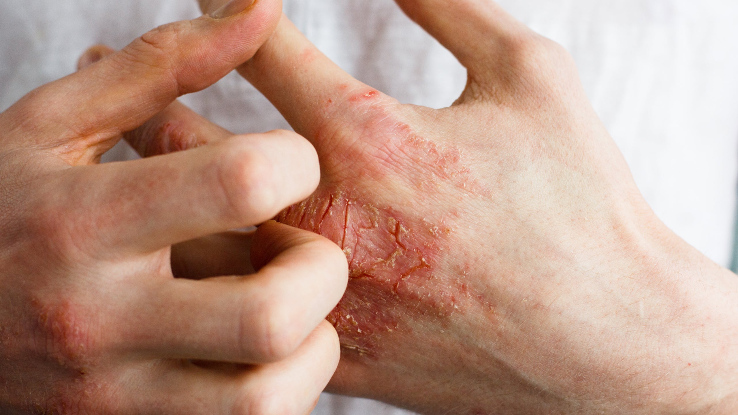 Itch 101: Why Eczema Is Such an Itchy Condition - Gladskin