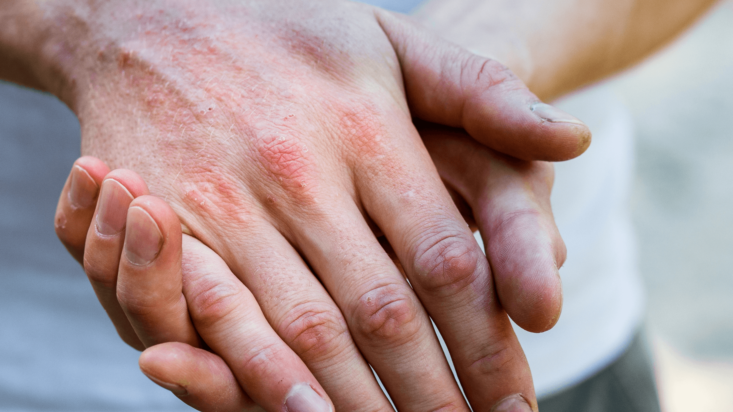 But How Long Does Eczema Last, Really? - Gladskin