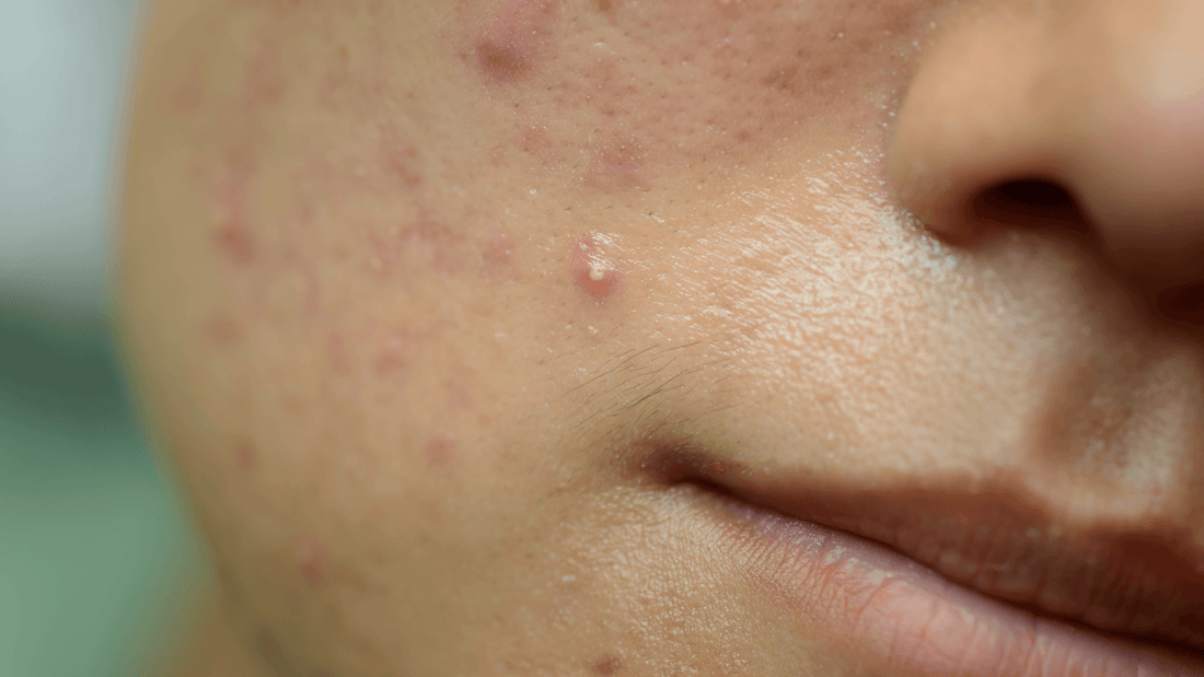 Types of Acne: Acne Vulgaris - Gladskin