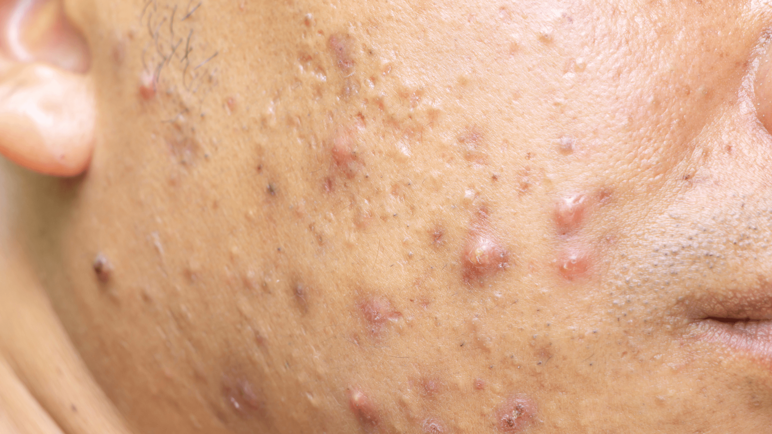 Types of Acne: Cystic Acne - Gladskin