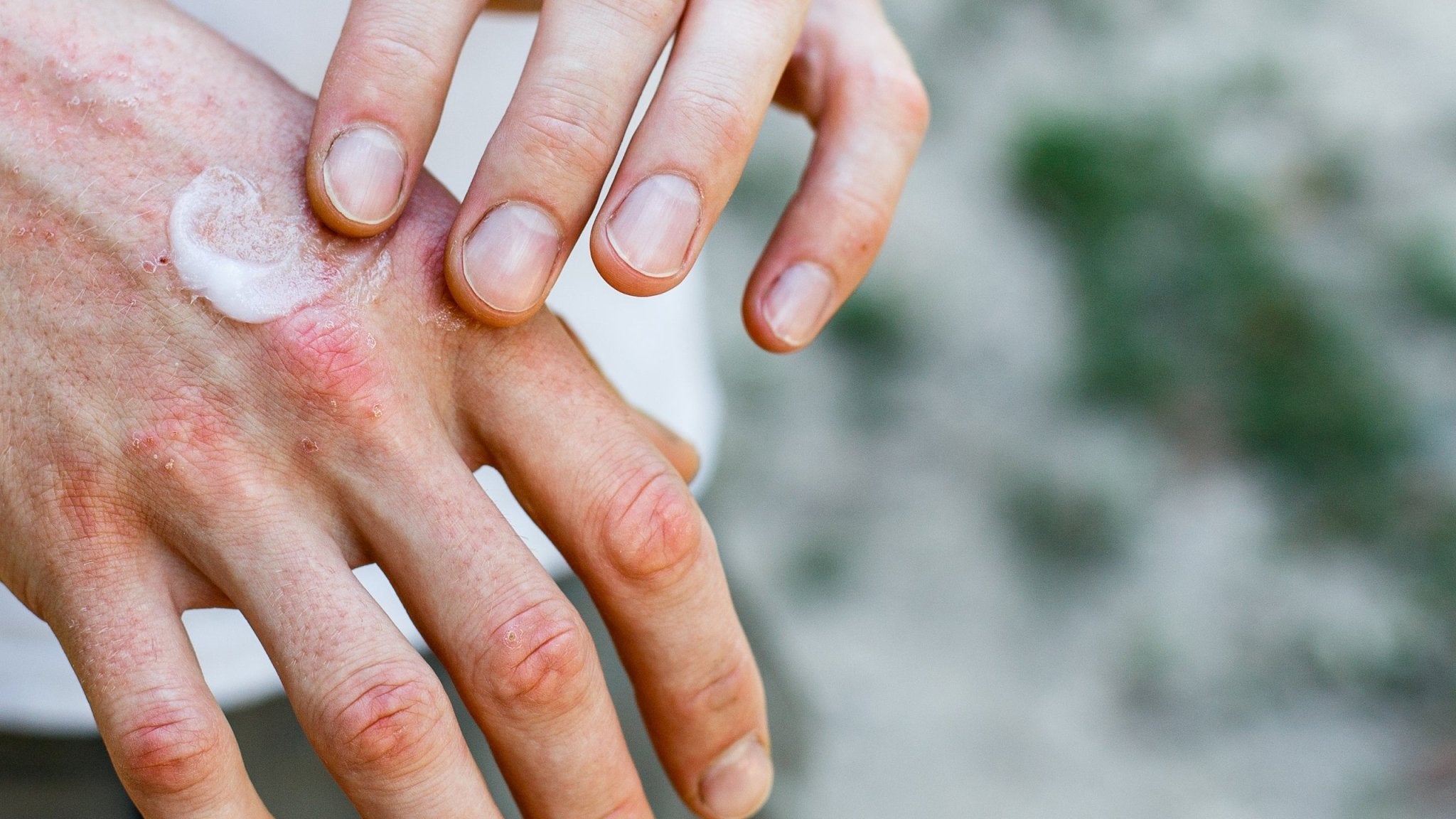 Dealing With Dry Hands in Winter? Here’s What to Do - Gladskin
