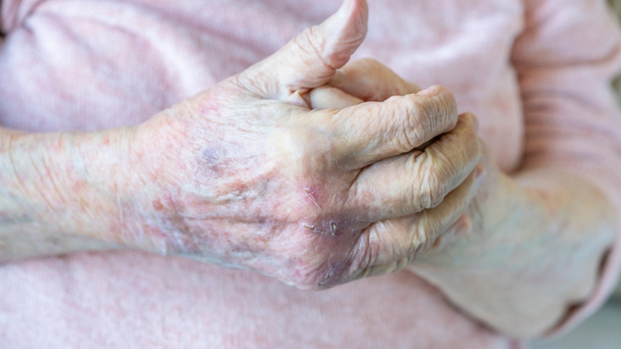 Eczema in Older Adults: Causes, Symptoms, and Treatment - Gladskin