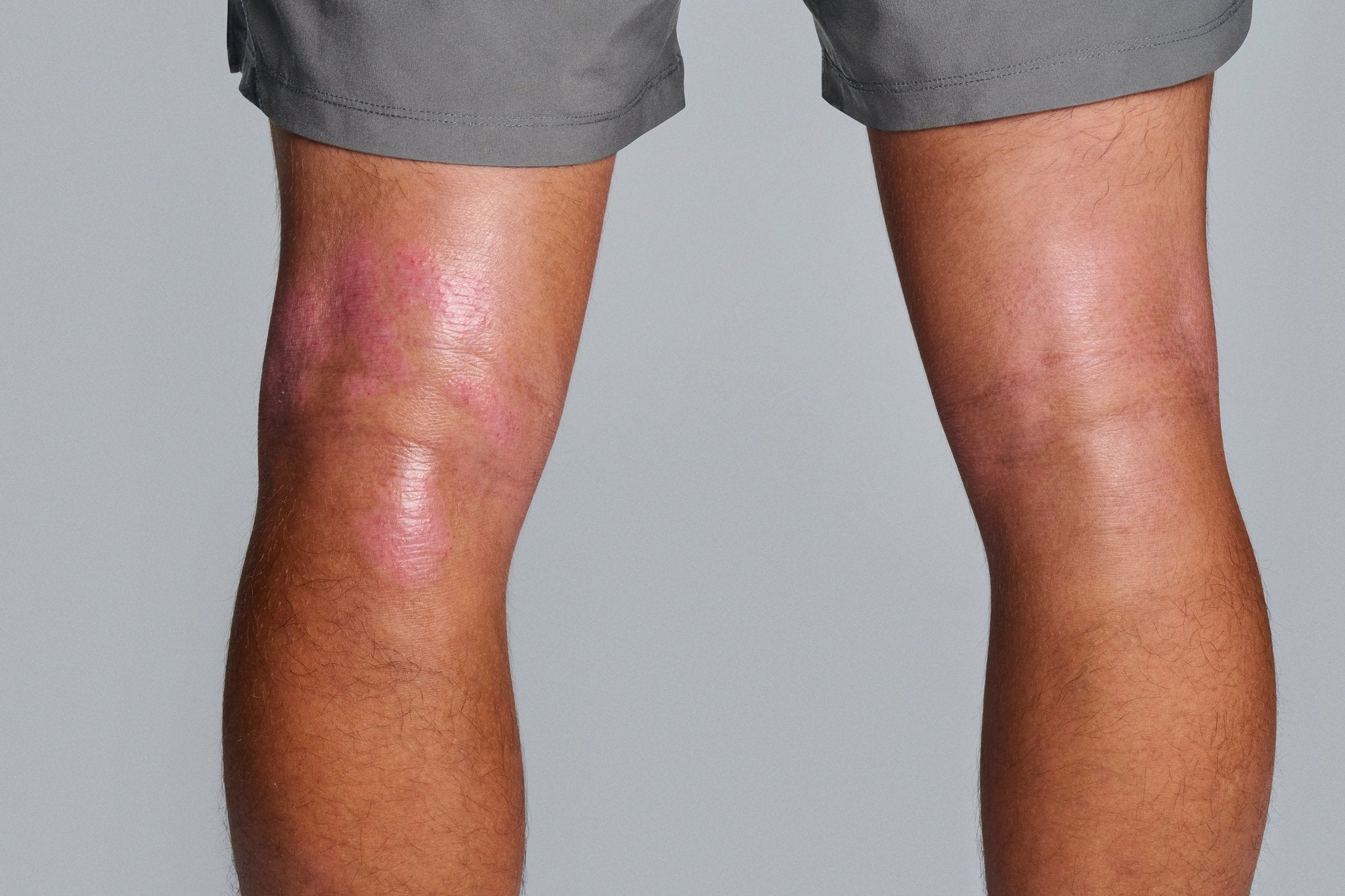 Eczema vs. Psoriasis: What's the Difference? - Gladskin